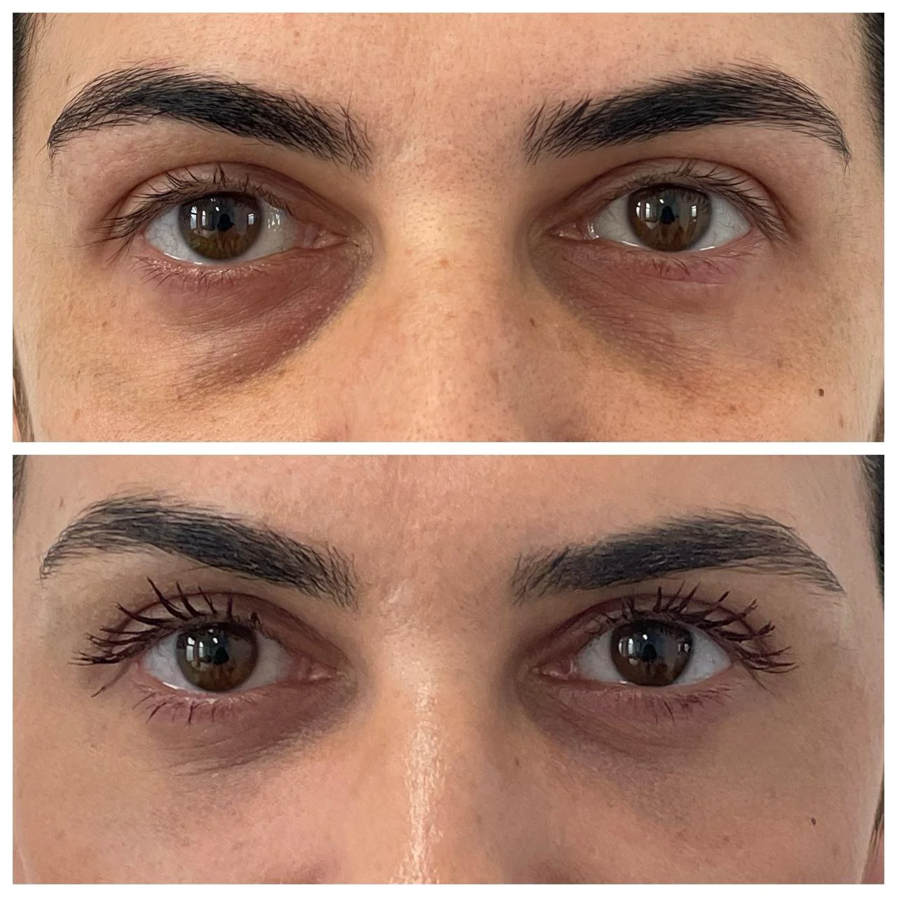 Vedere frontală înainte și la 4 zile după blefaroplastie inferioară transconjunctivală cu lipofilling
