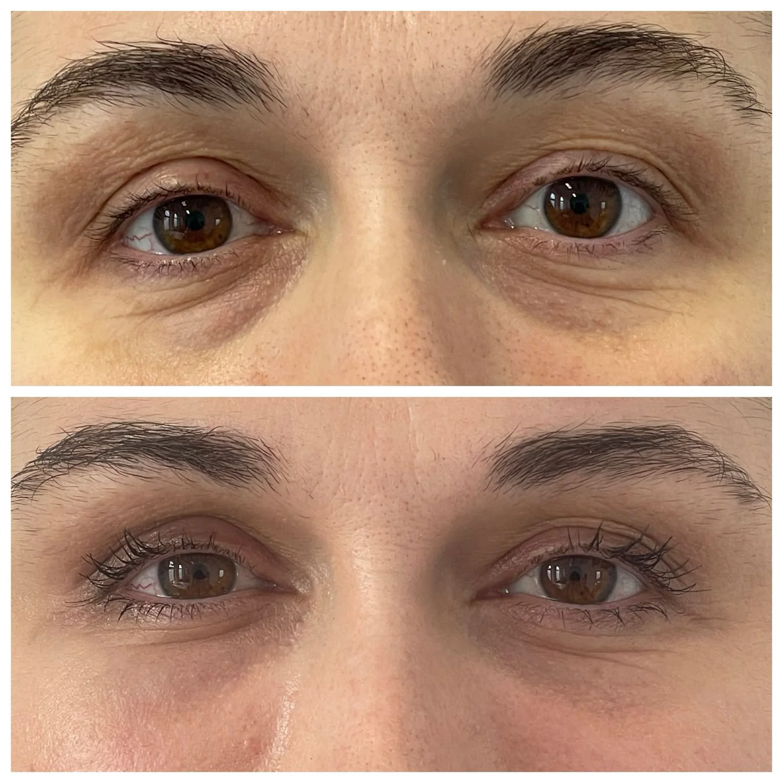 Rezultat la 6 săptămâni după lipofilling periocular și laser CO2, fără excizie chirurgicală