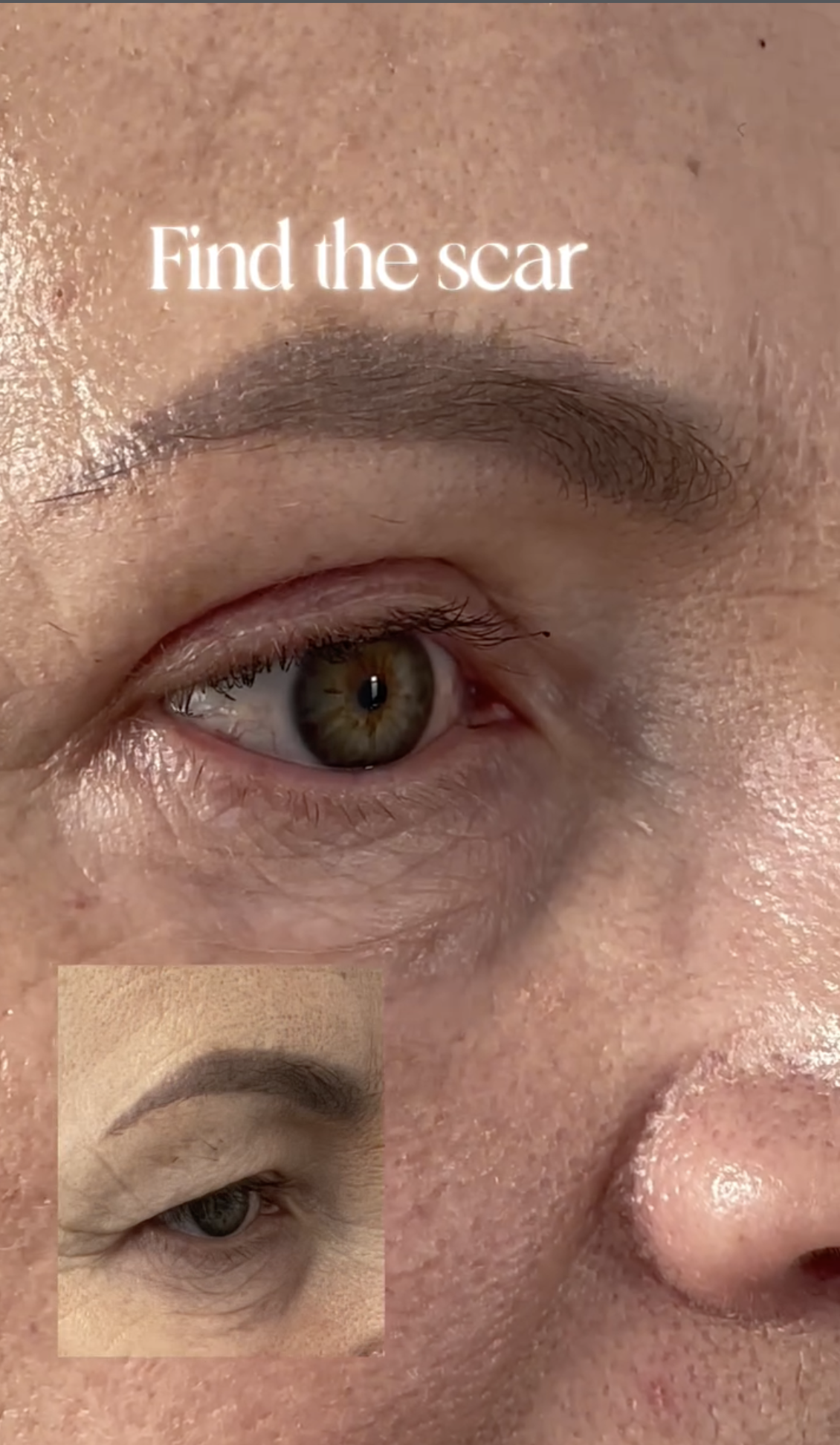 Rezultat la 1 an după Blefaroplastie Superioară