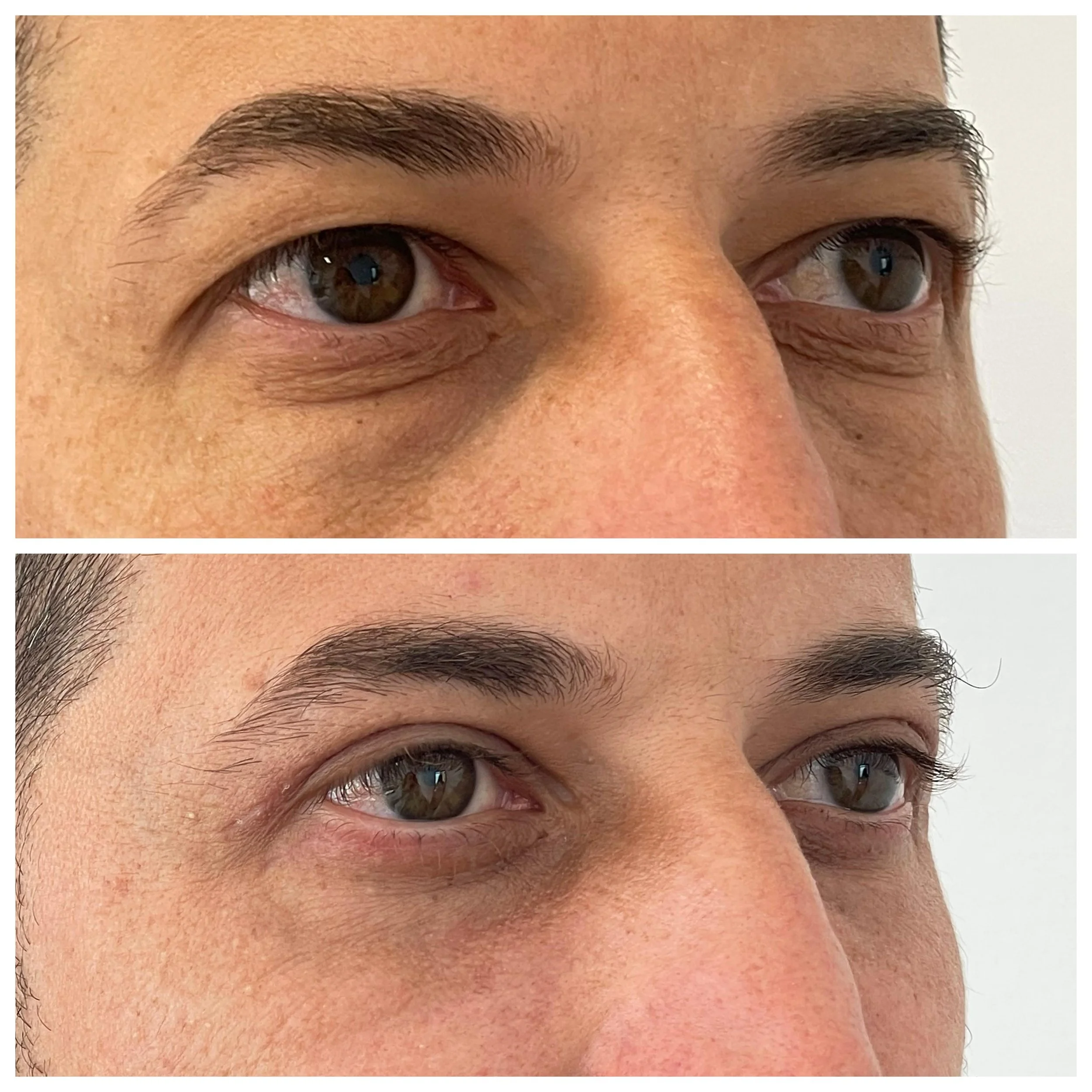 Comparație înainte și după procedura de blefaroplastie - vedere din dreapta