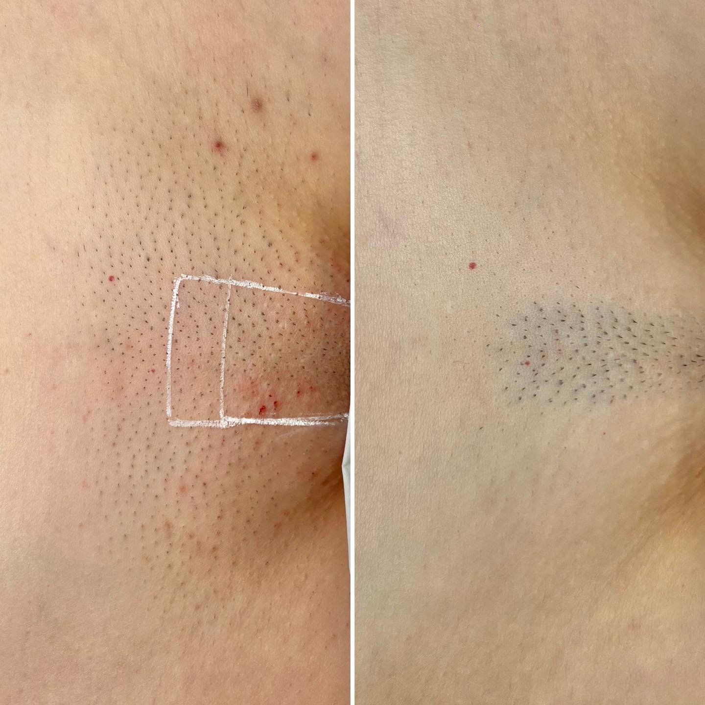Clear, bright, smooth skin, with no irritation, no rash, no shadow. Low maintenance. One of the best beauty treatments you&rsquo;ll spend money on.  #devonlaser #nevershaveagain #loveyourskin #barnstaplelaserhairremoval #laserhairremoval #laserhairre