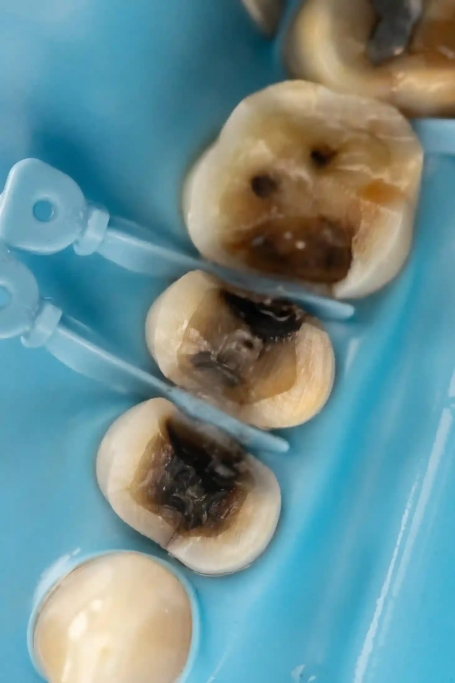 Clinical photo of a molar during deep decay and crack removal