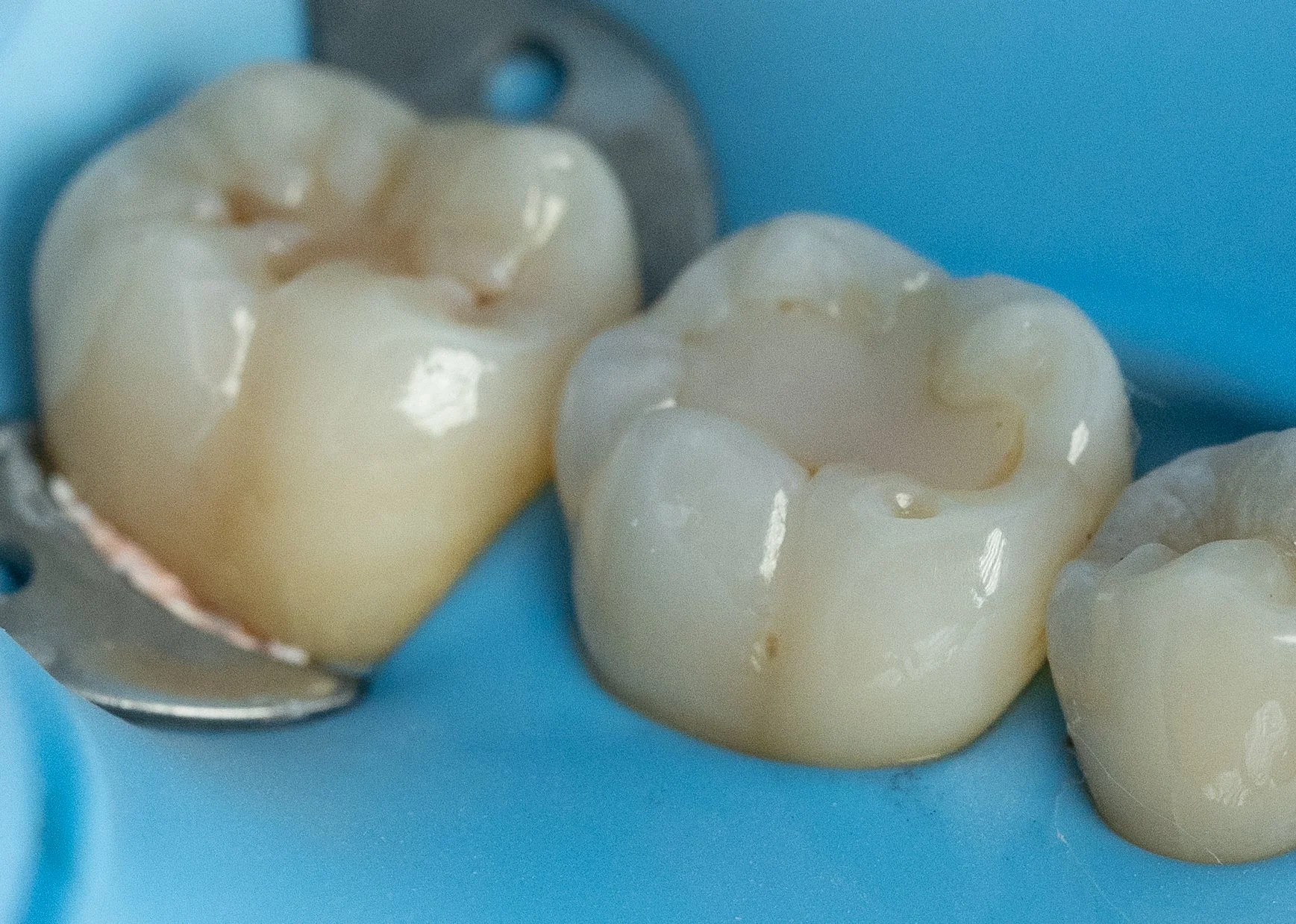 Close-up of a molar before composite (tooth-colored) filling restoration