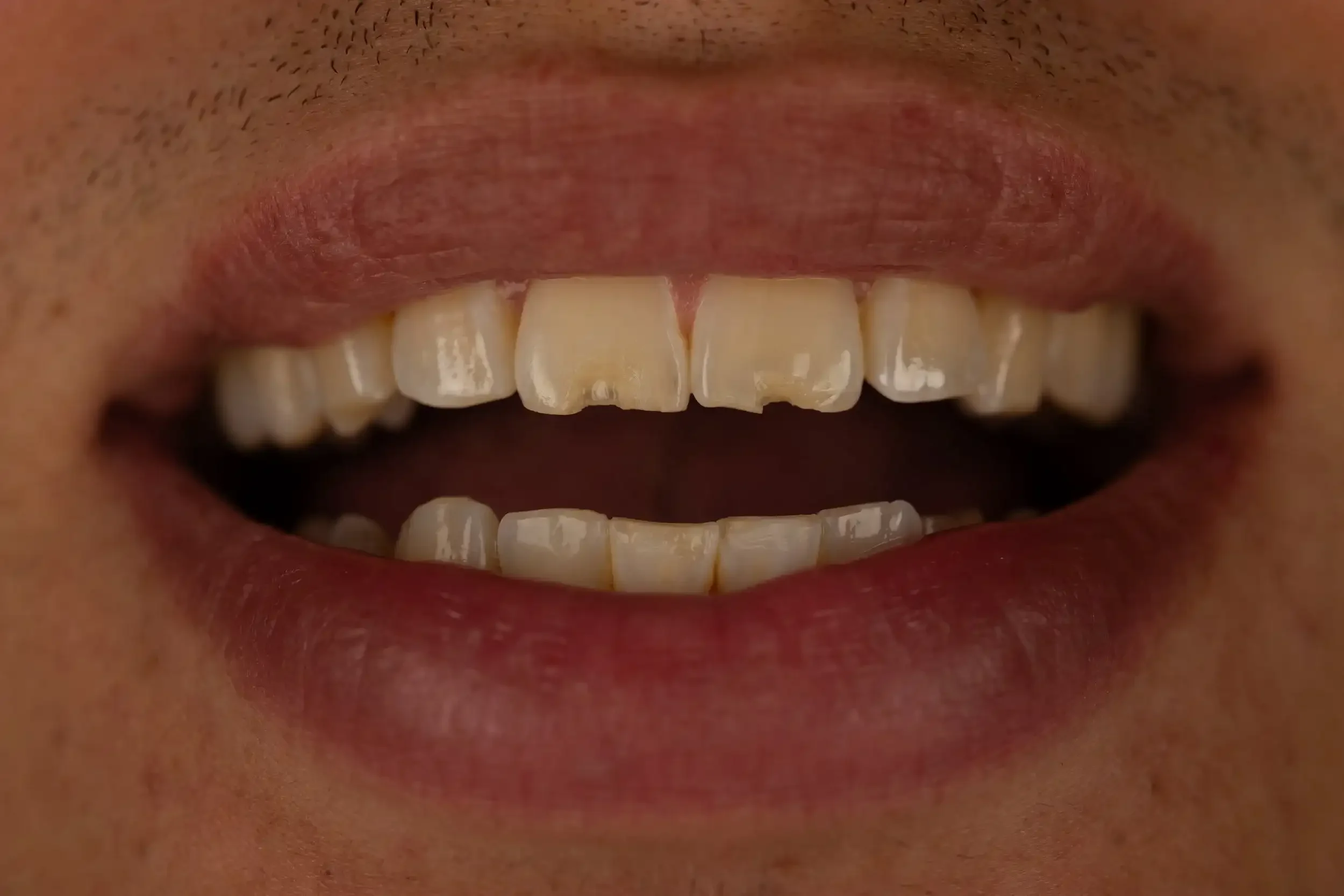 Close-up of a person's mouth showing upper and lower teeth, with visible skin texture and some facial hair surrounding the lips.