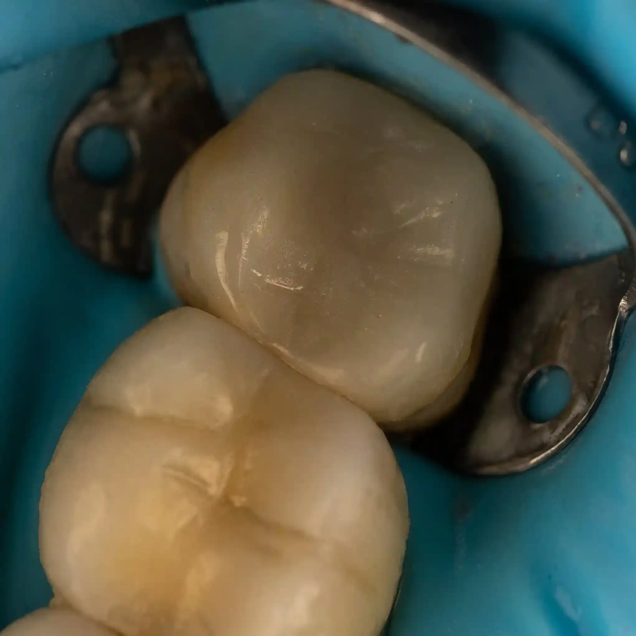 Clinical photo of a molar restored with a bonded ceramic overlay