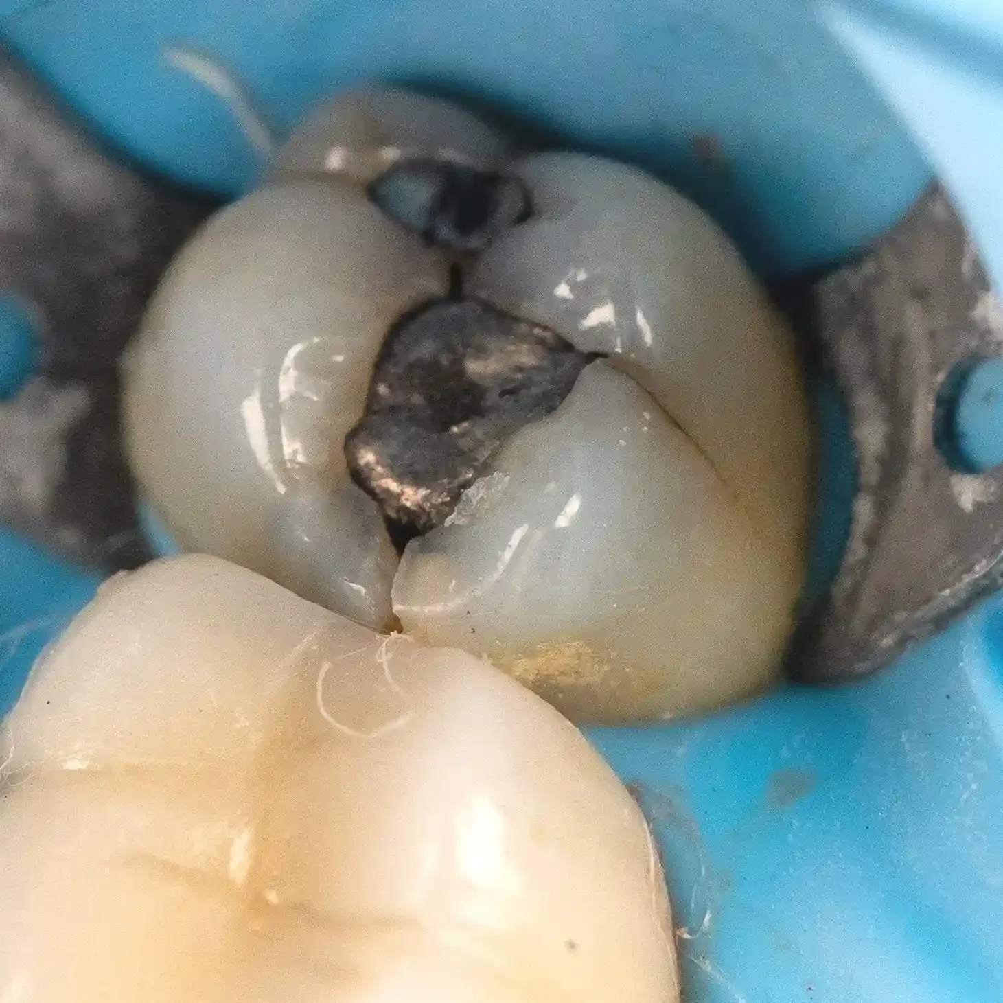 Clinical photo of a molar with a cracked metal restoration before treatment