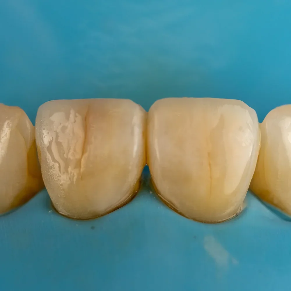 Close-up of several teeth with a blue background.