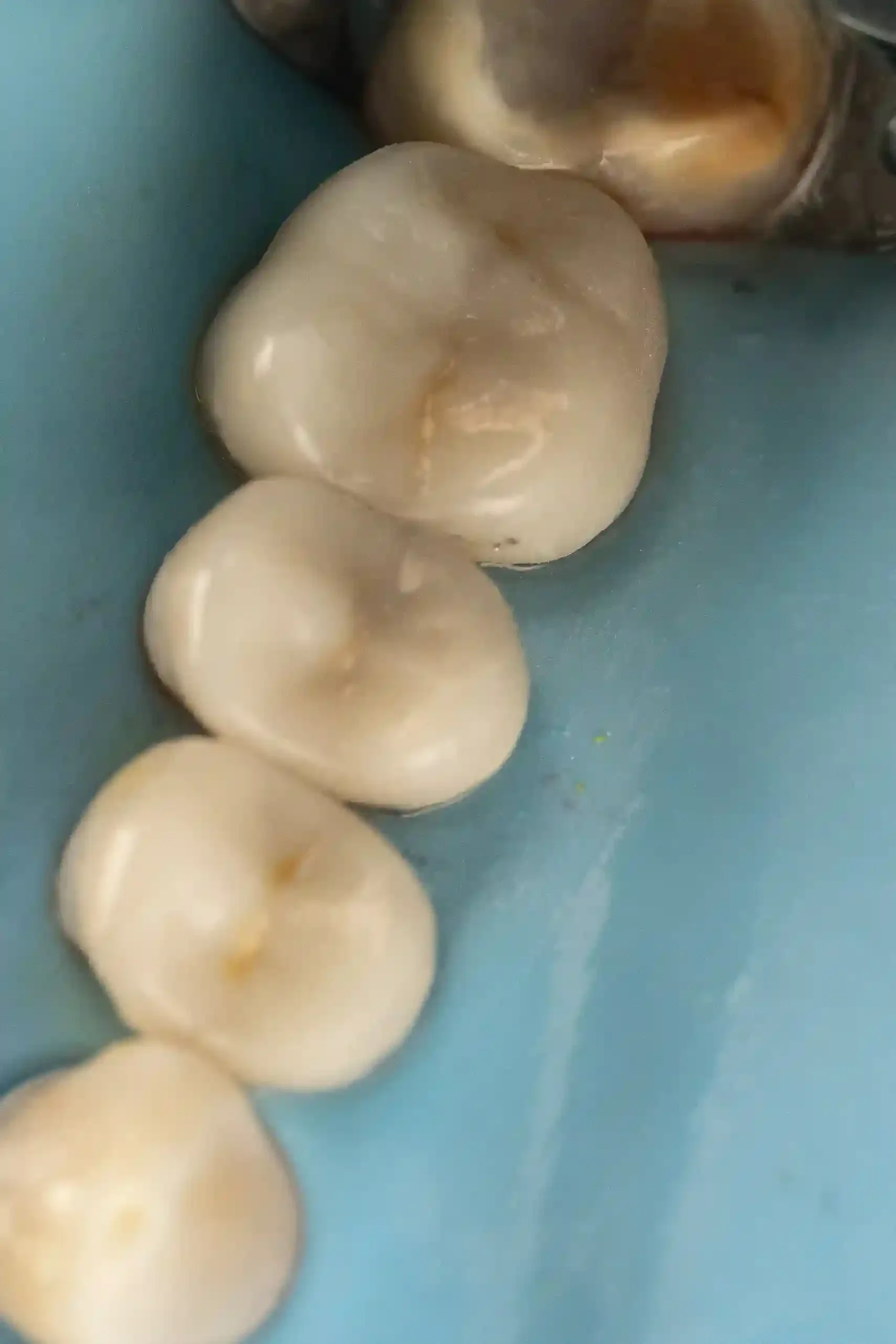 Clinical photo of a molar after sealing with immediate dentin sealing before overlay placement