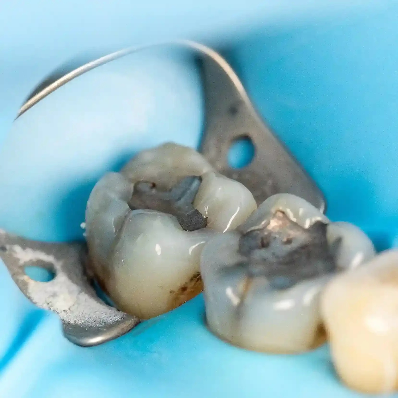 Clinical photo of two adjacent molars with old metal fillings before treatment