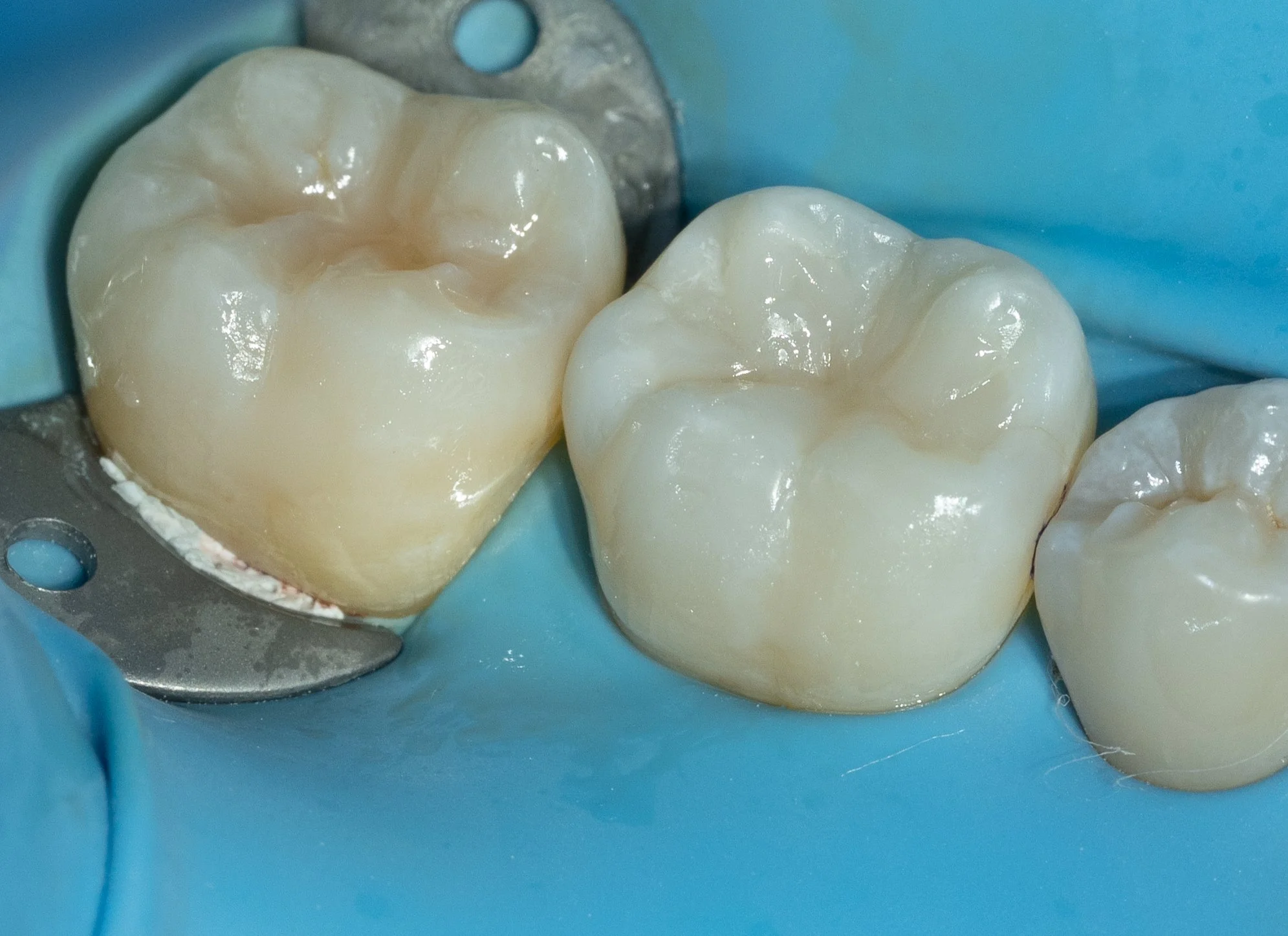 Close-up of the same molar after composite (tooth-colored) filling restoration