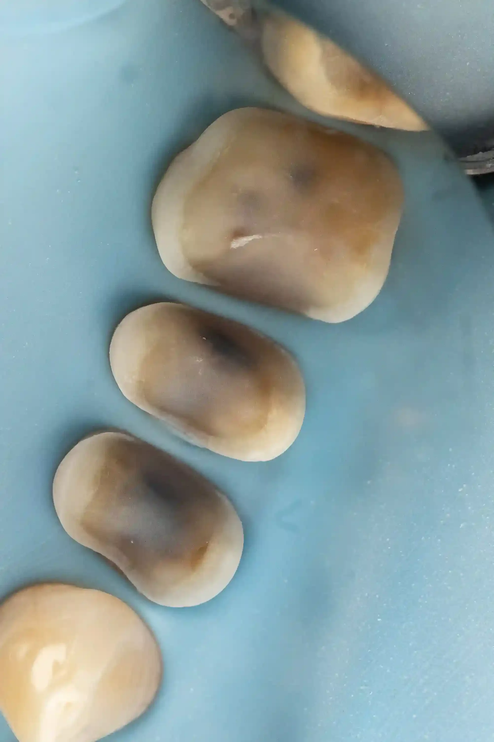 Clinical photo of a molar after sealing with immediate dentin sealing before overlay placement