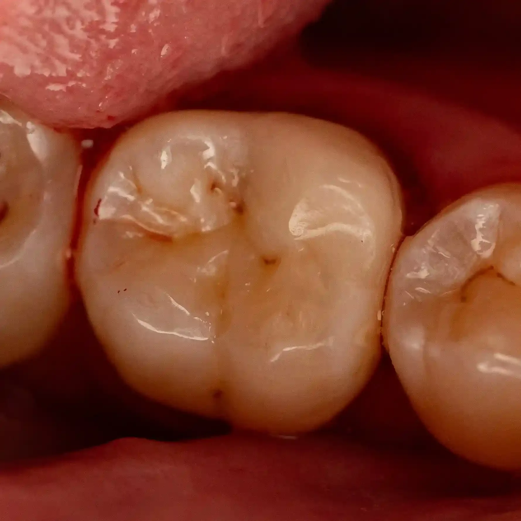 Clinical photo of a molar restored with a bonded ceramic onlay