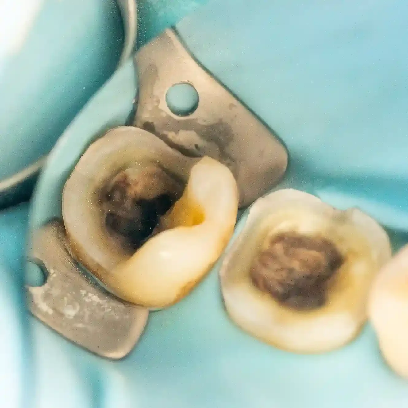 Clinical photo of two molars prepared for an onlay (left) and an overlay (right)