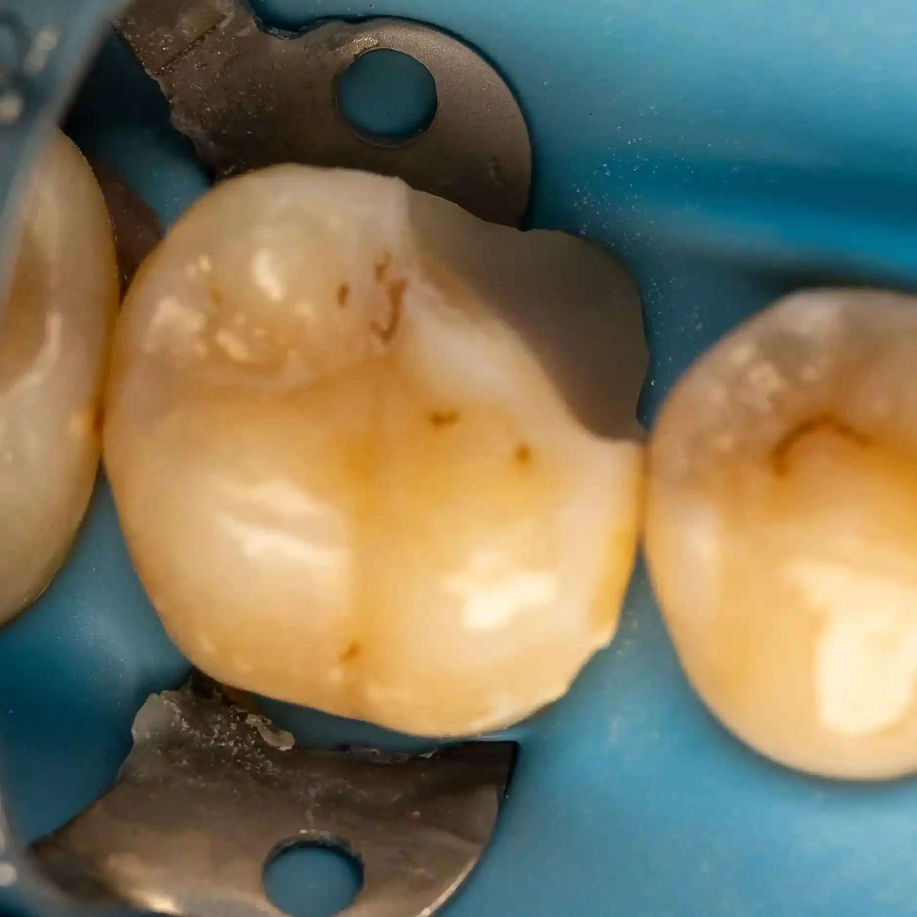 Clinical photo of a molar after deep margin elevation and sealing, ready for a ceramic onlay