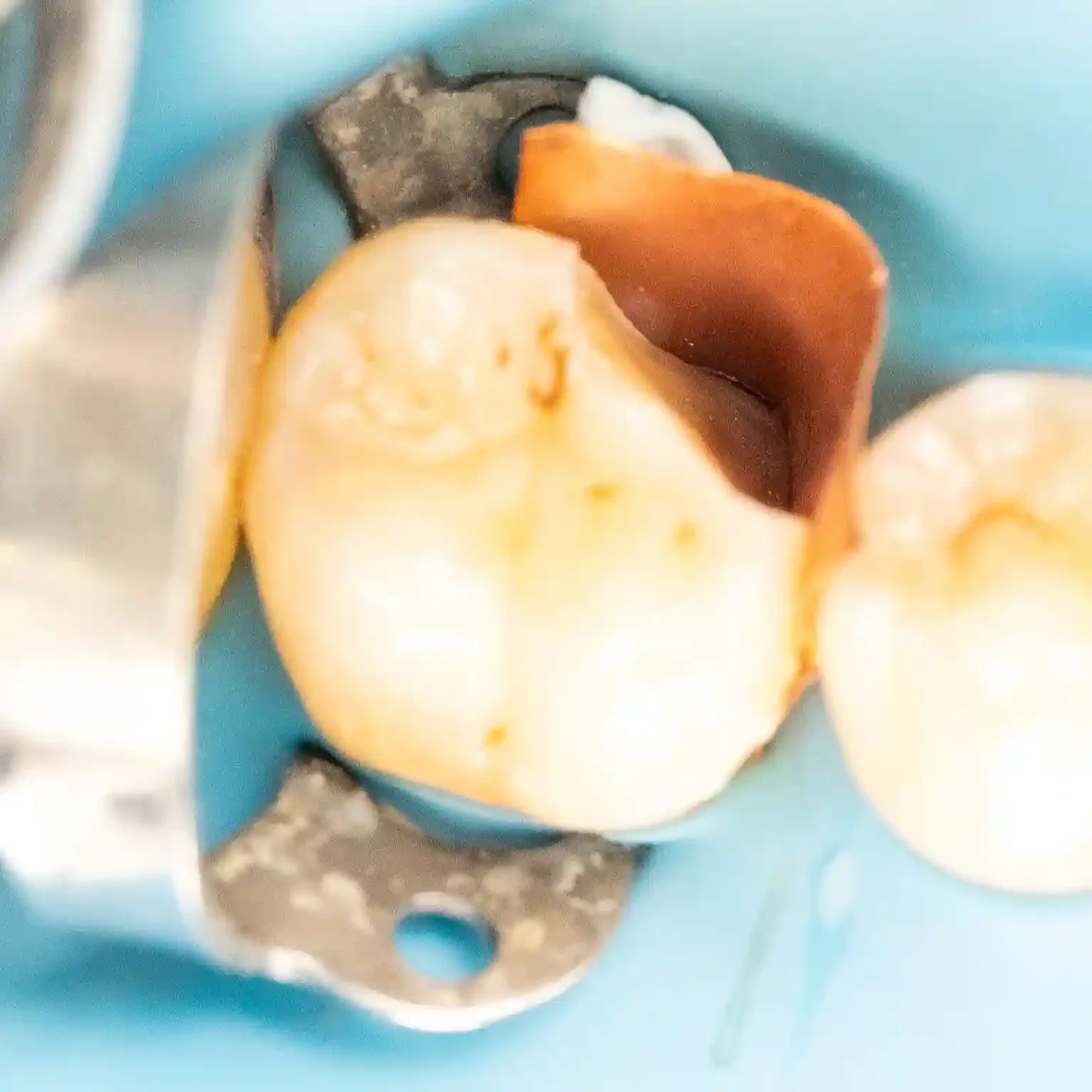 Clinical photo of a molar isolated with a rubber dam showing exposed dentin and staining