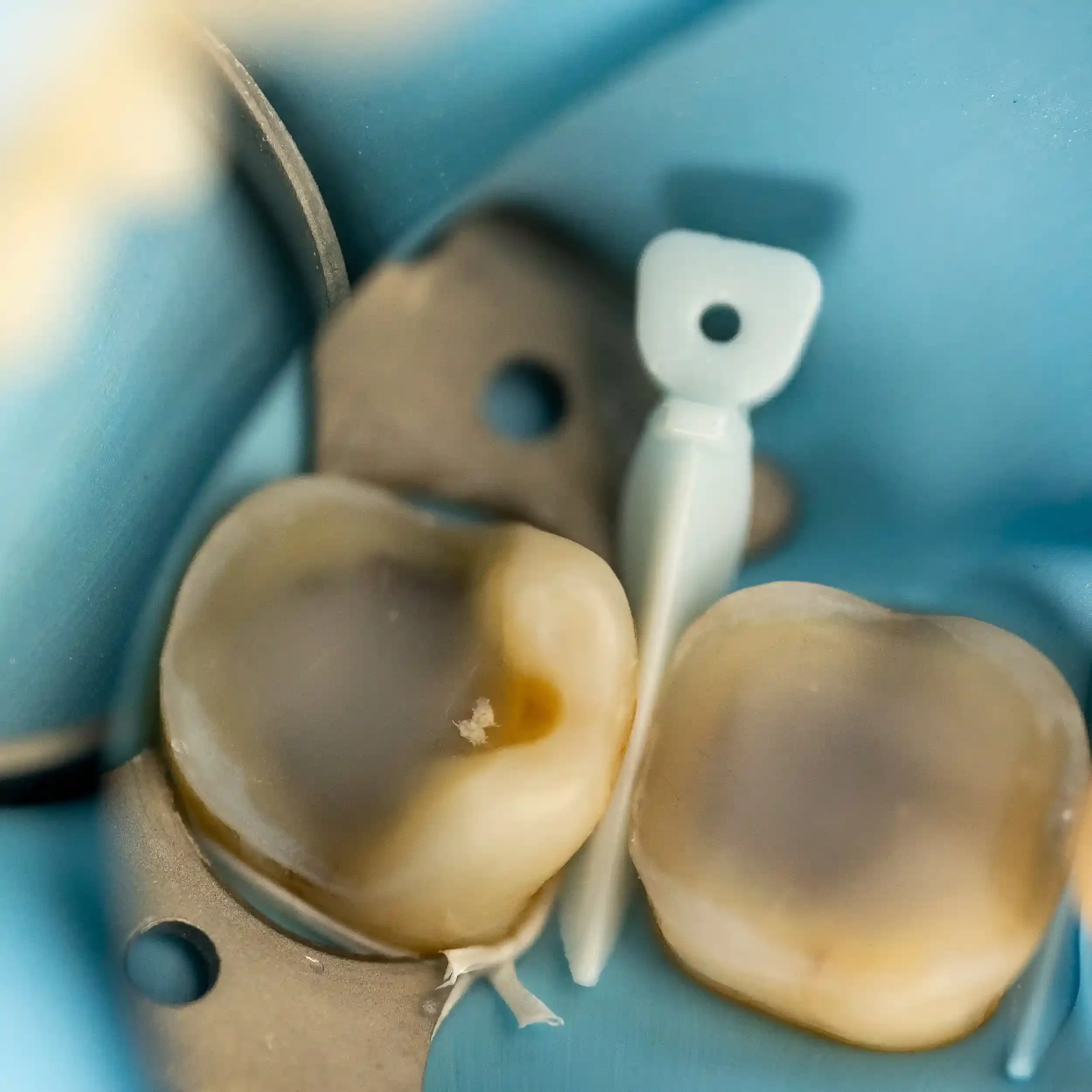 Clinical photo of two sealed tooth preparations ready for ceramic restorations