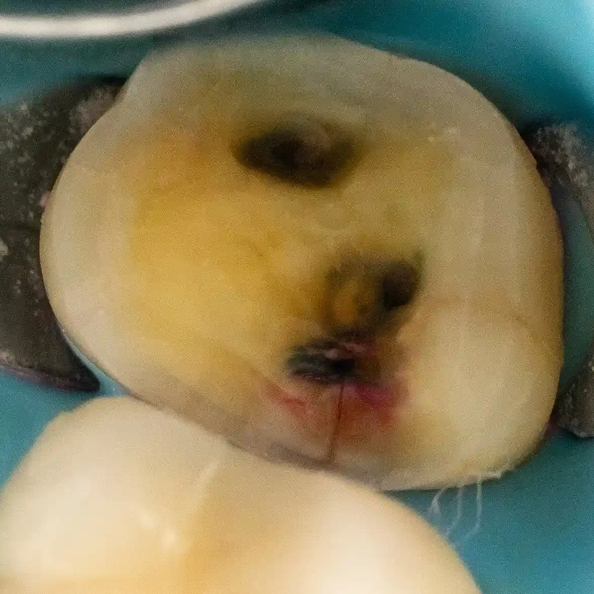 Clinical photo of a molar during removal of deep decay, exposing dark staining