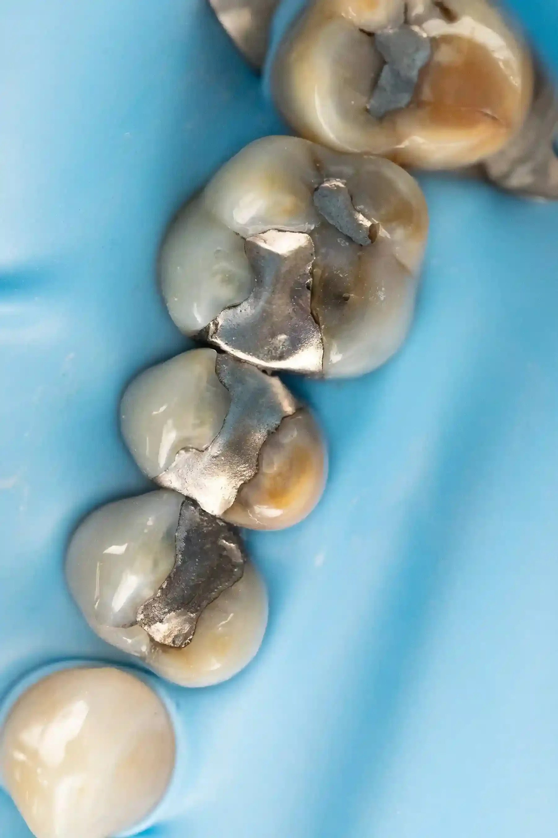 Clinical photo of a molar with a cracked, leaking metal restoration before treatment