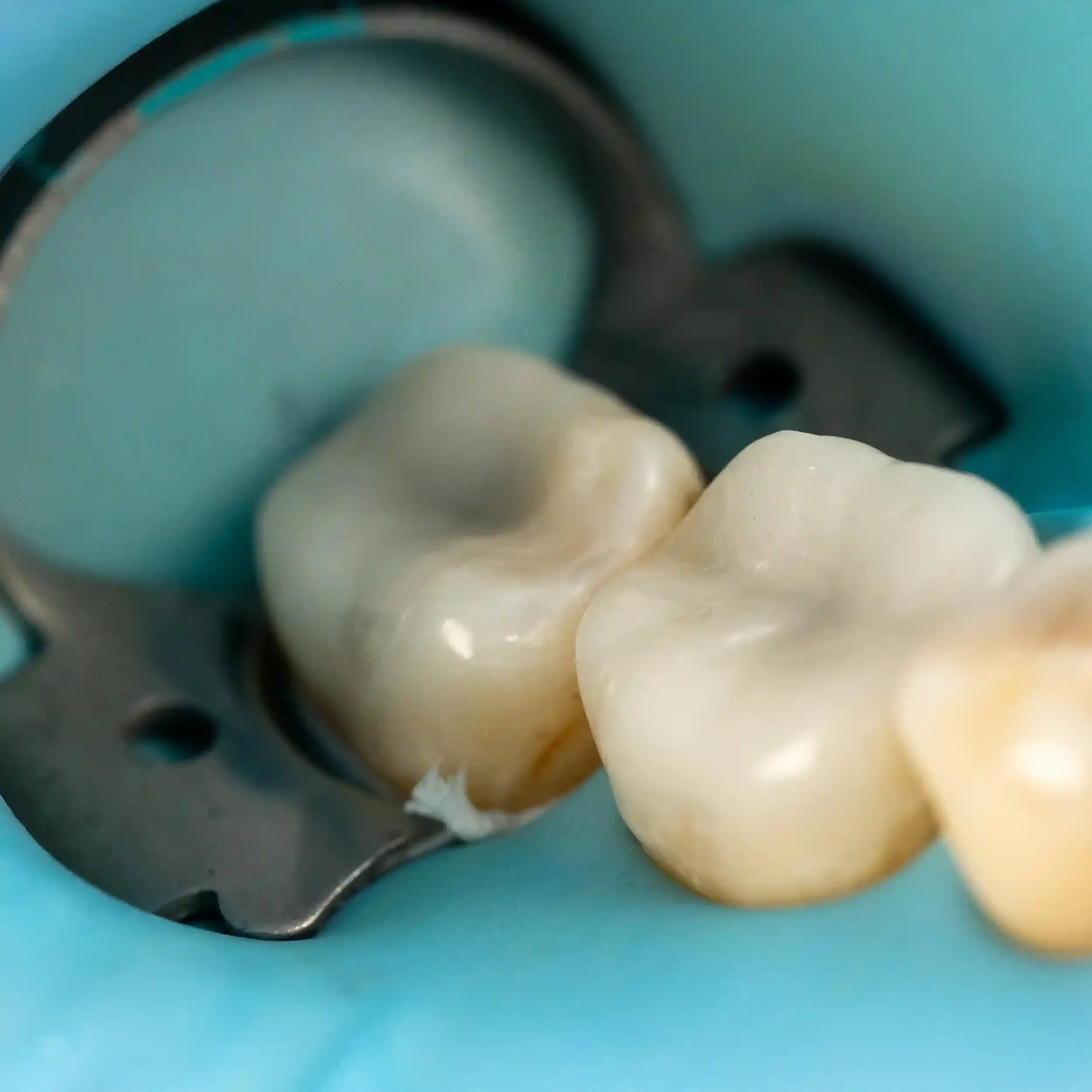 Clinical photo of a molar restored with a ceramic onlay (left) and overlay (right)