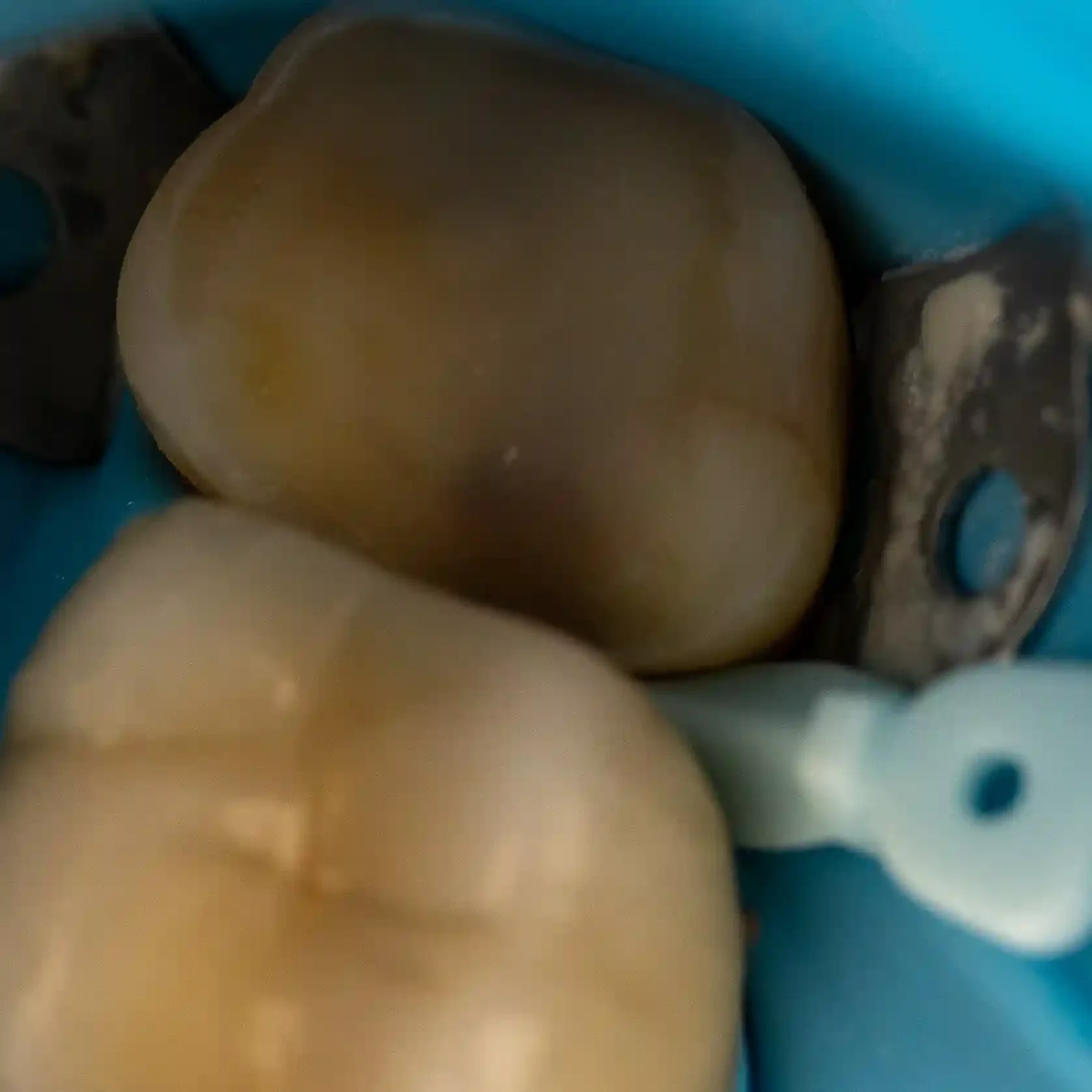 Clinical photo of a molar after sealing and ribbond placement, ready for a ceramic overlay