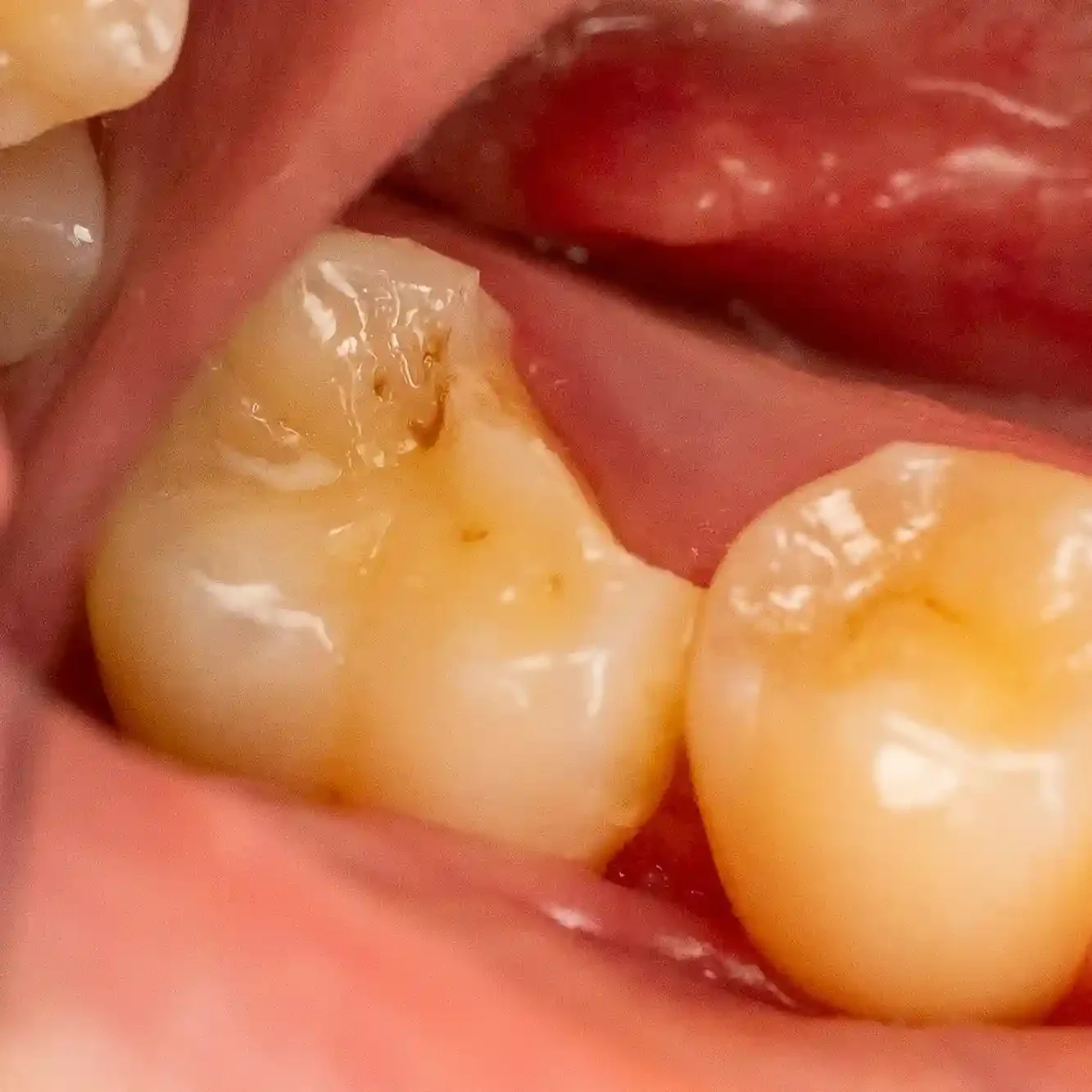 Clinical photo of a molar with a fractured cusp before treatment