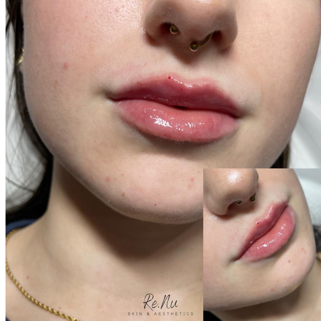 Lip filler after.png