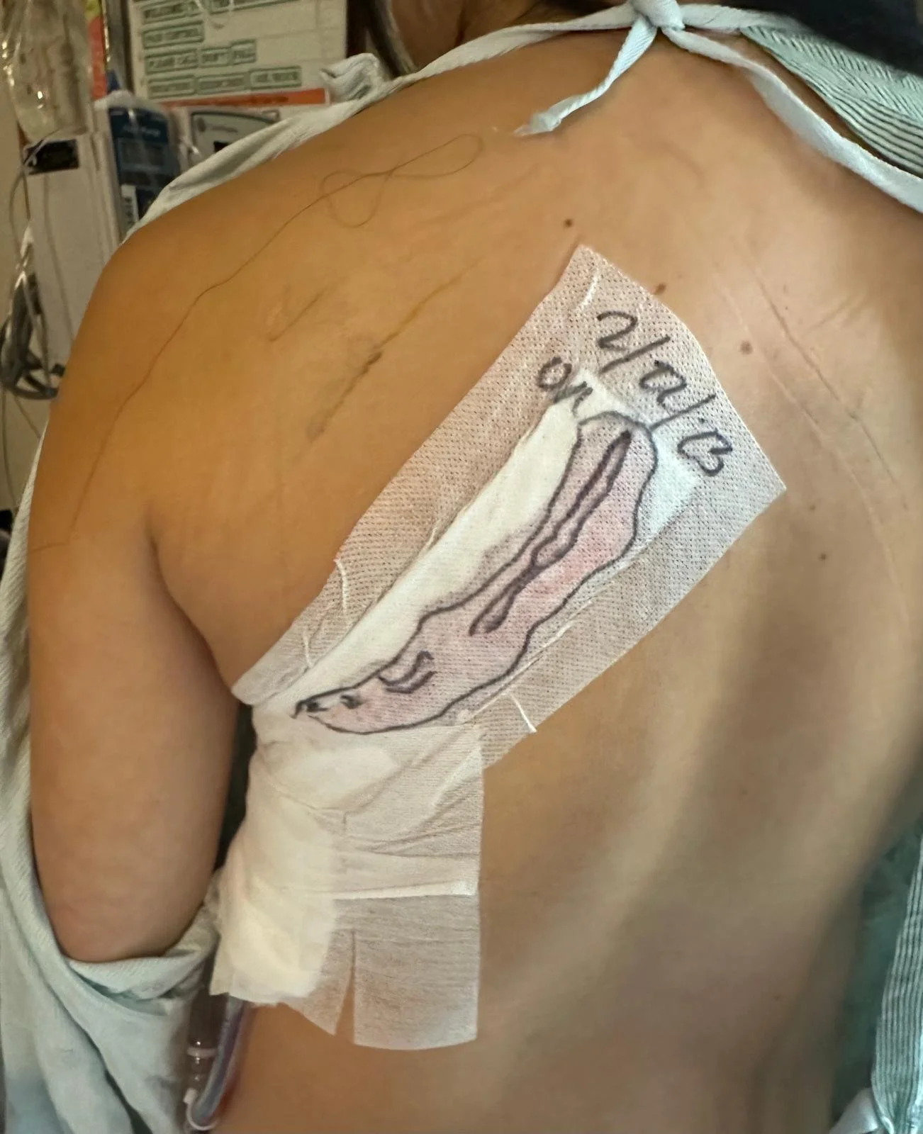 Shows Kimberly's back where she had surgery