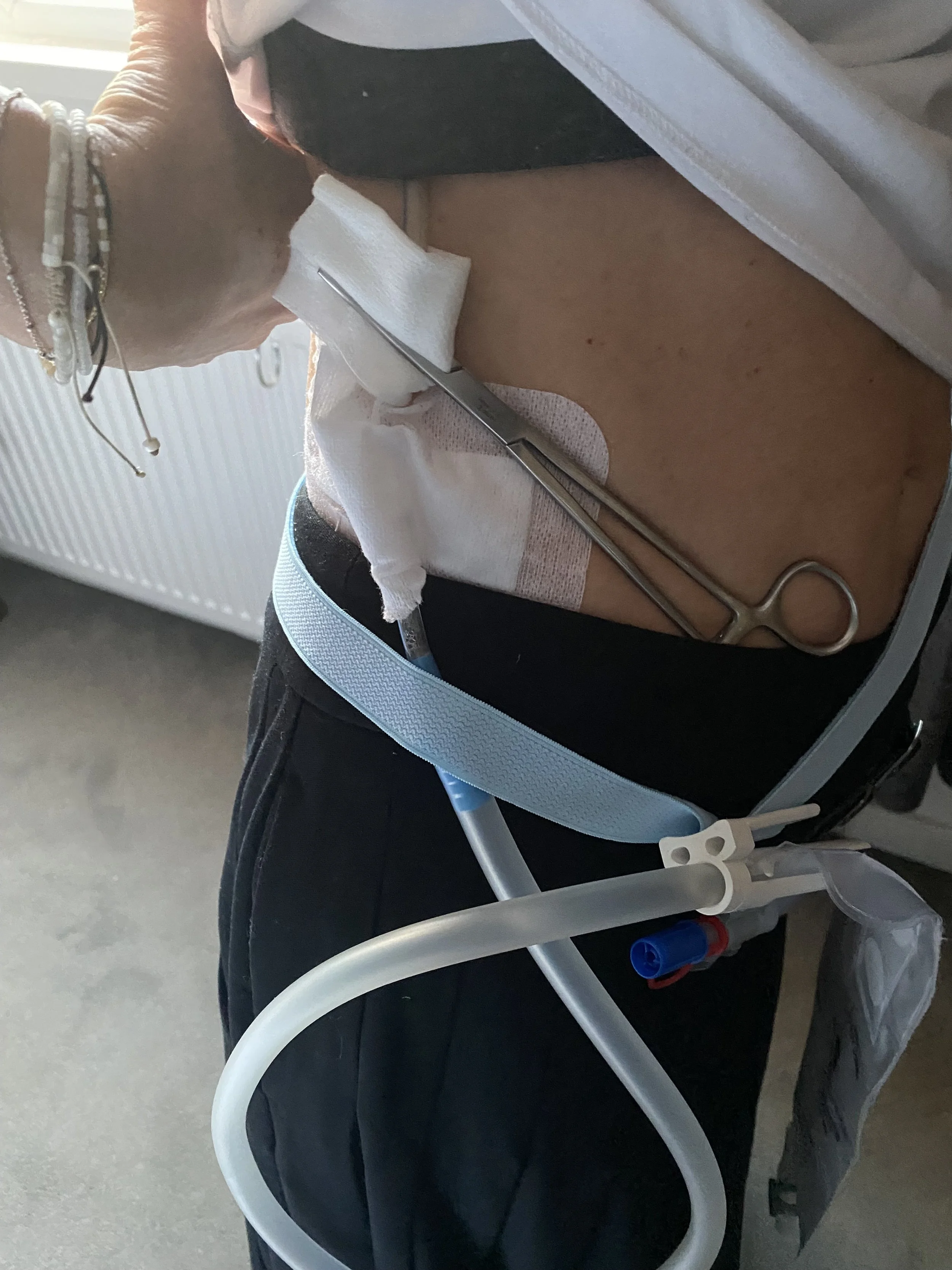 Close up photo of Natasha's torso showing all the tubes and even surgical scissors holding up gauze