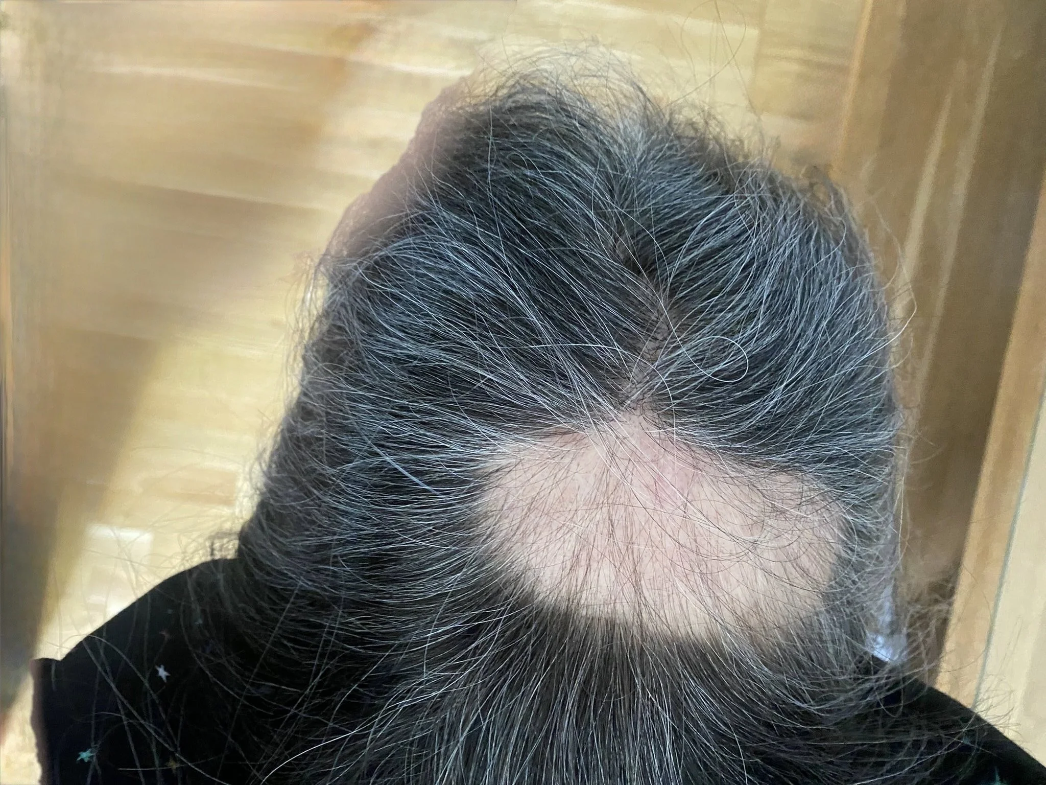 Close up of a massive bald patch on Nicol's head to the area where she received the gamma knife radiotherapy to treat her brain mets from her lung cancer.