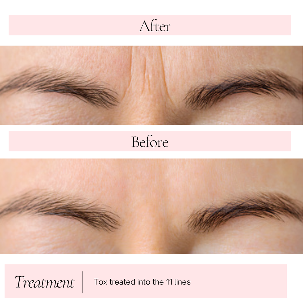 Frown lines (11s) before and after tox for a client near Kearney, MO