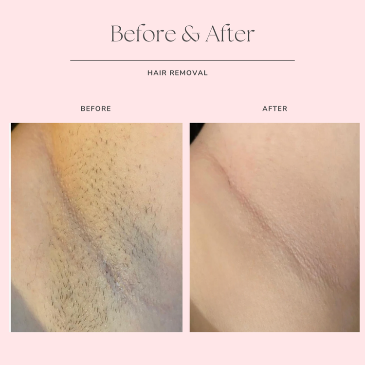 Underarm laser hair removal before and after at Skin Affaire MedSpa