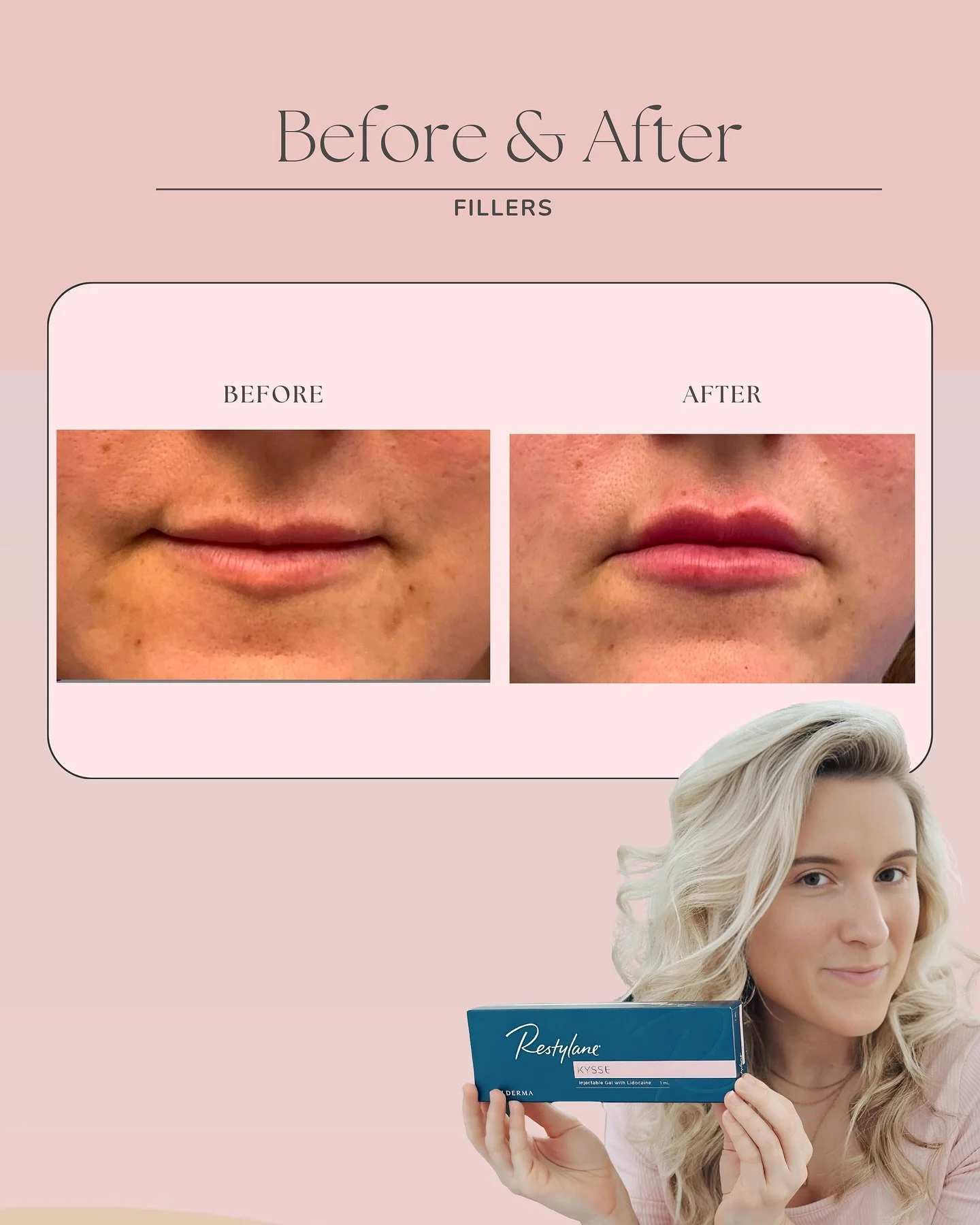 Experience the difference that expertly placed fillers can make.  Real results from one of our recent treatments subtle, natural-looking enhancement that brings out your best features.

At Skin Affaire MedSpa, we believe in empowering women to feel c