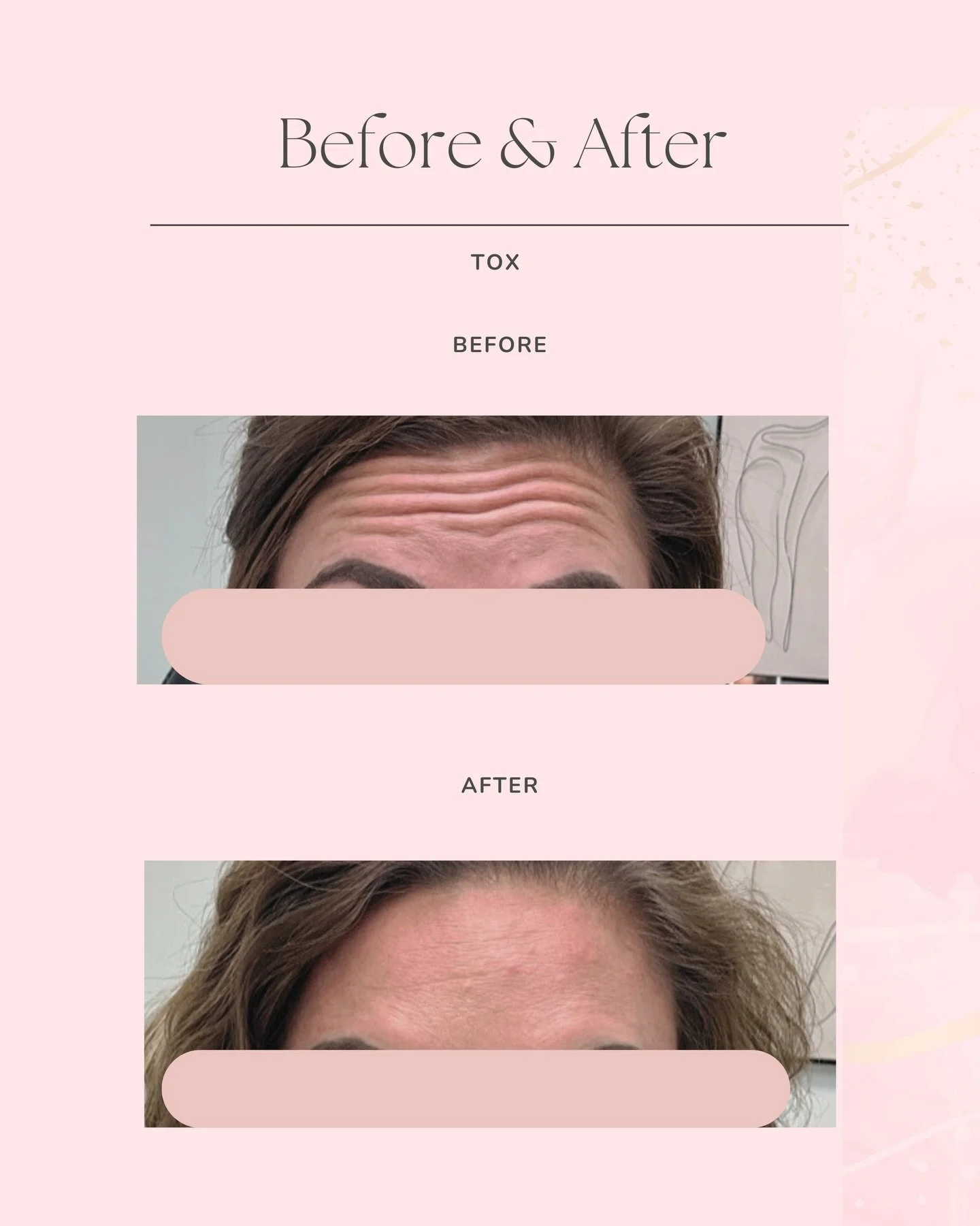 There is something so powerful about looking in the mirror and seeing a reflection that matches how vibrant you feel inside. This transformation isn&rsquo;t just about smoothing out lines: it&rsquo;s about that feeling of being completely refreshed a