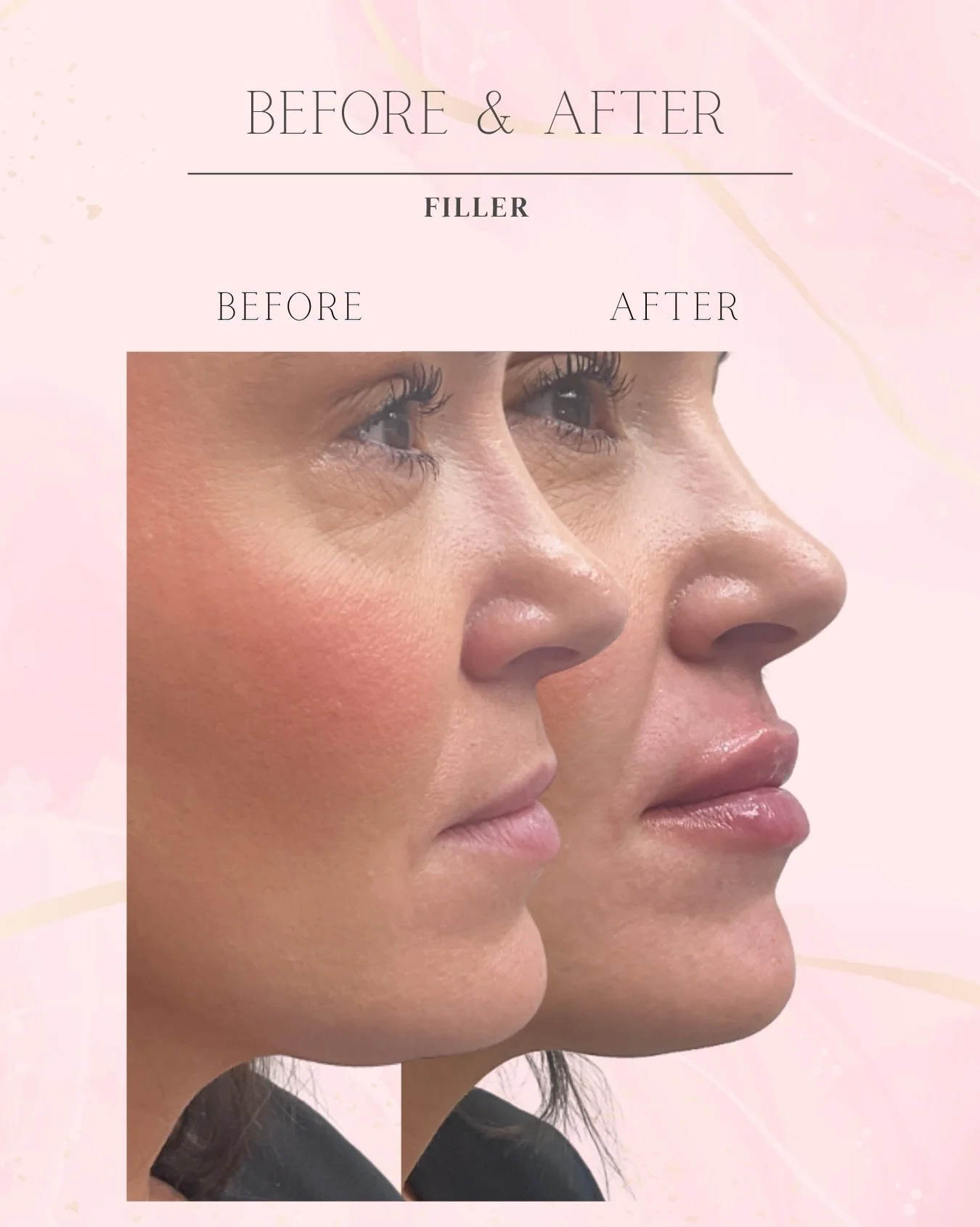 Natural results, maximum confidence. 💋 
She wanted:
✨ Better balance
✨ More definition
✨ A softer, more youthful appearance
Mission accomplished. 💉💋
The best filler results don&rsquo;t scream &ldquo;I got filler.&rdquo;
They make people wonder why
