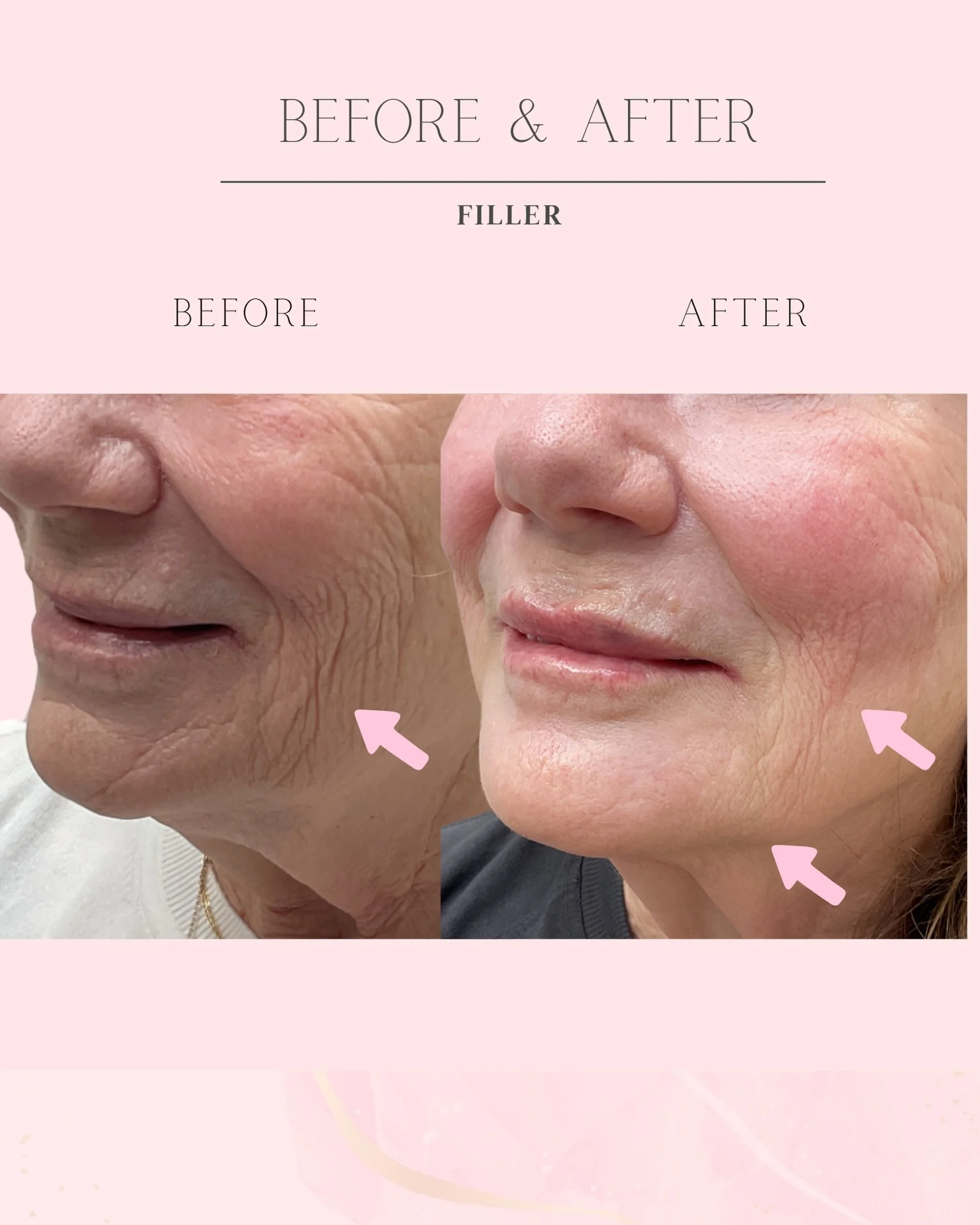 ✨ Before &amp; After Filler Treatment ✨
By restoring lost volume and providing support to the mid and lower face, filler helped soften deep accordion lines and marionette lines while enhancing facial contours. The result is a smoother, more refreshed
