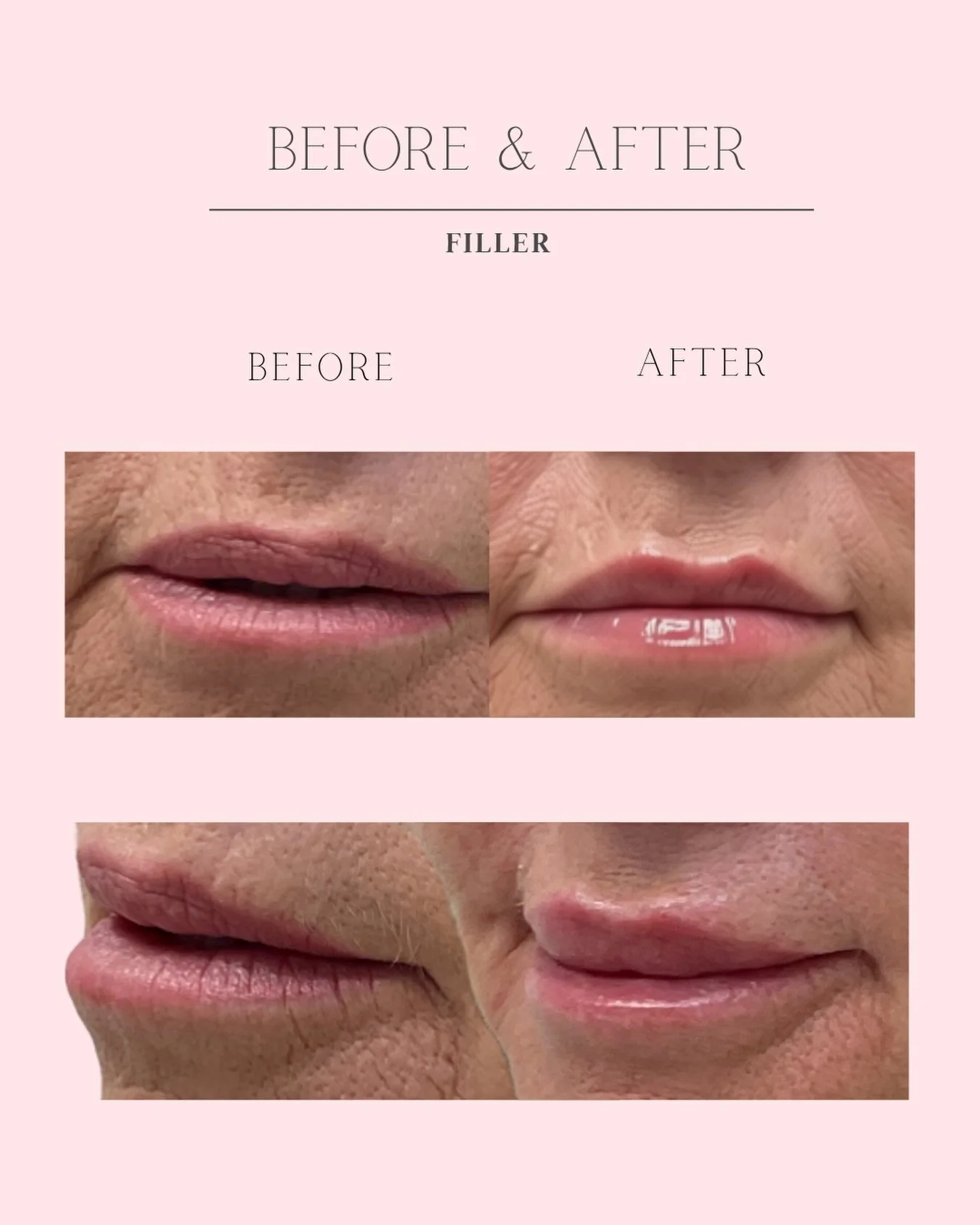 Not every lip filler treatment is about creating bigger lips.

Sometimes it&rsquo;s about restoring what time has gradually taken away.

As we age, our lips naturally lose collagen, hydration, and definition. The goal isn&rsquo;t to change who you ar