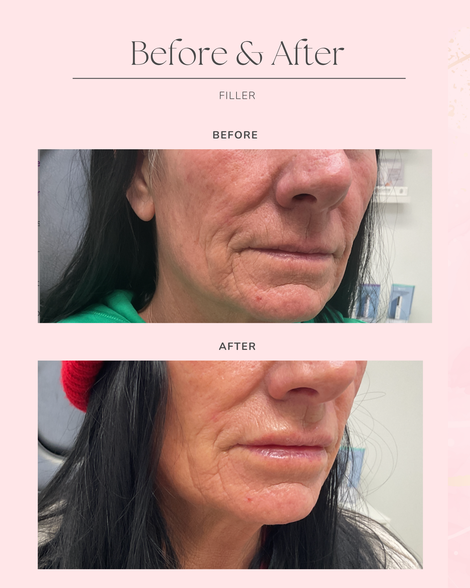 Botox & Filler Pink Post Feed (35).png