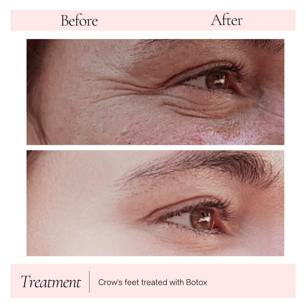 Crow's feet before and after Botox near Liberty, MO
