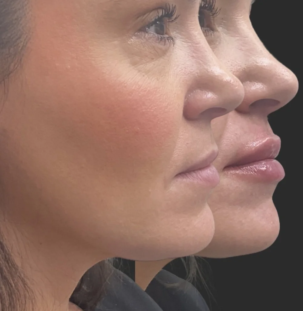 Lip filler before and after for a client near Liberty, MO