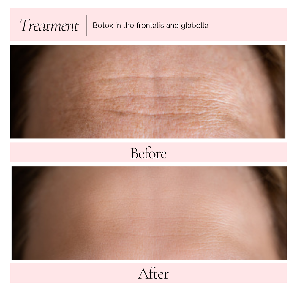 Forehead lines before and after Botox for a client near Liberty, MO