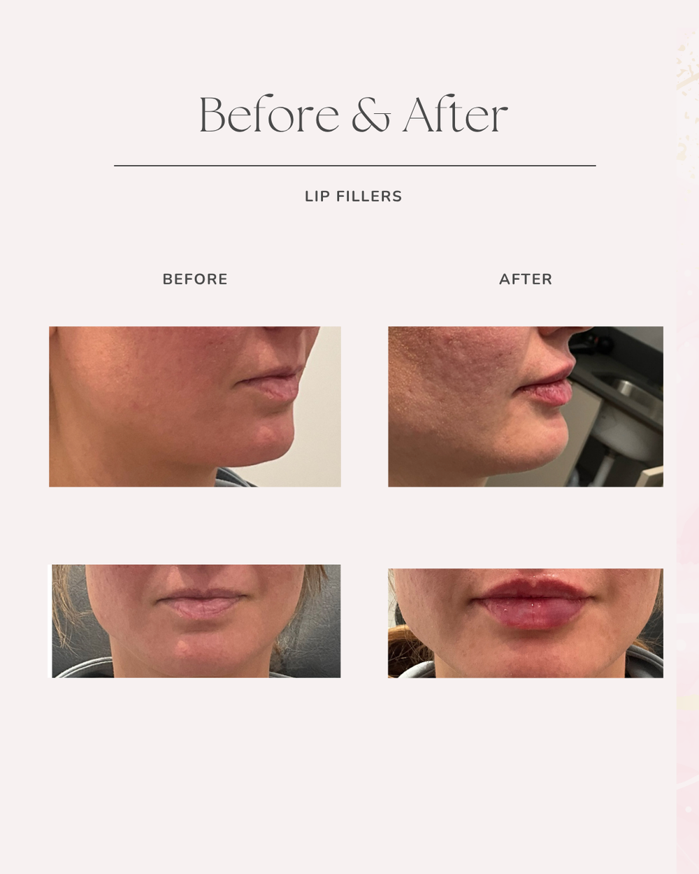 Lip filler before and after at Skin Affaire MedSpa, 12 minutes from Kearney, MO