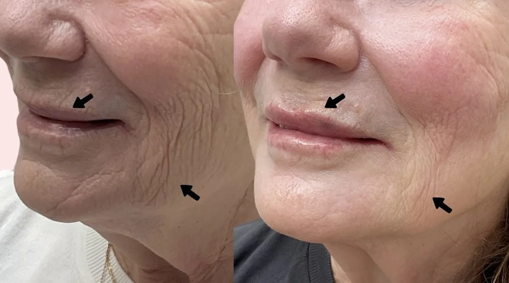 Smile line and accordion line filler before and after near Kearney, MO