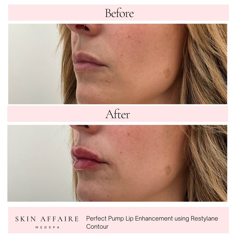 Restylane lip filler before and after near Liberty, MO