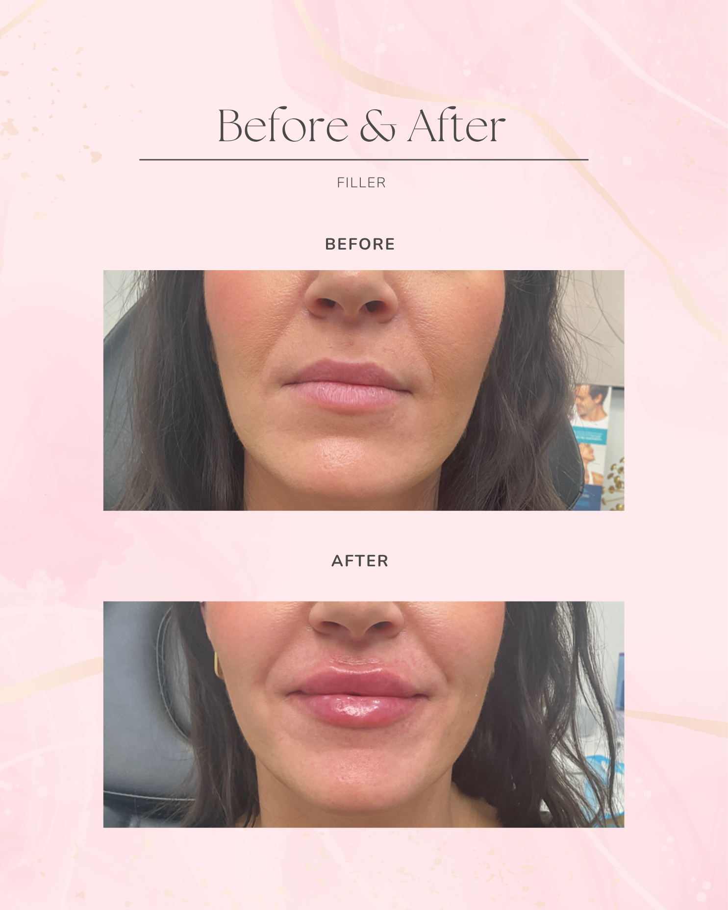 Botox & Filler Pink Post Feed (33).png