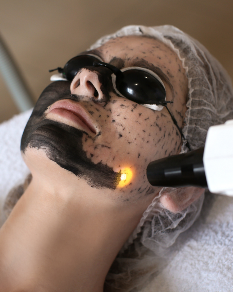 Carbon facial laser treatment at Skin Affaire MedSpa in Excelsior Springs, MO