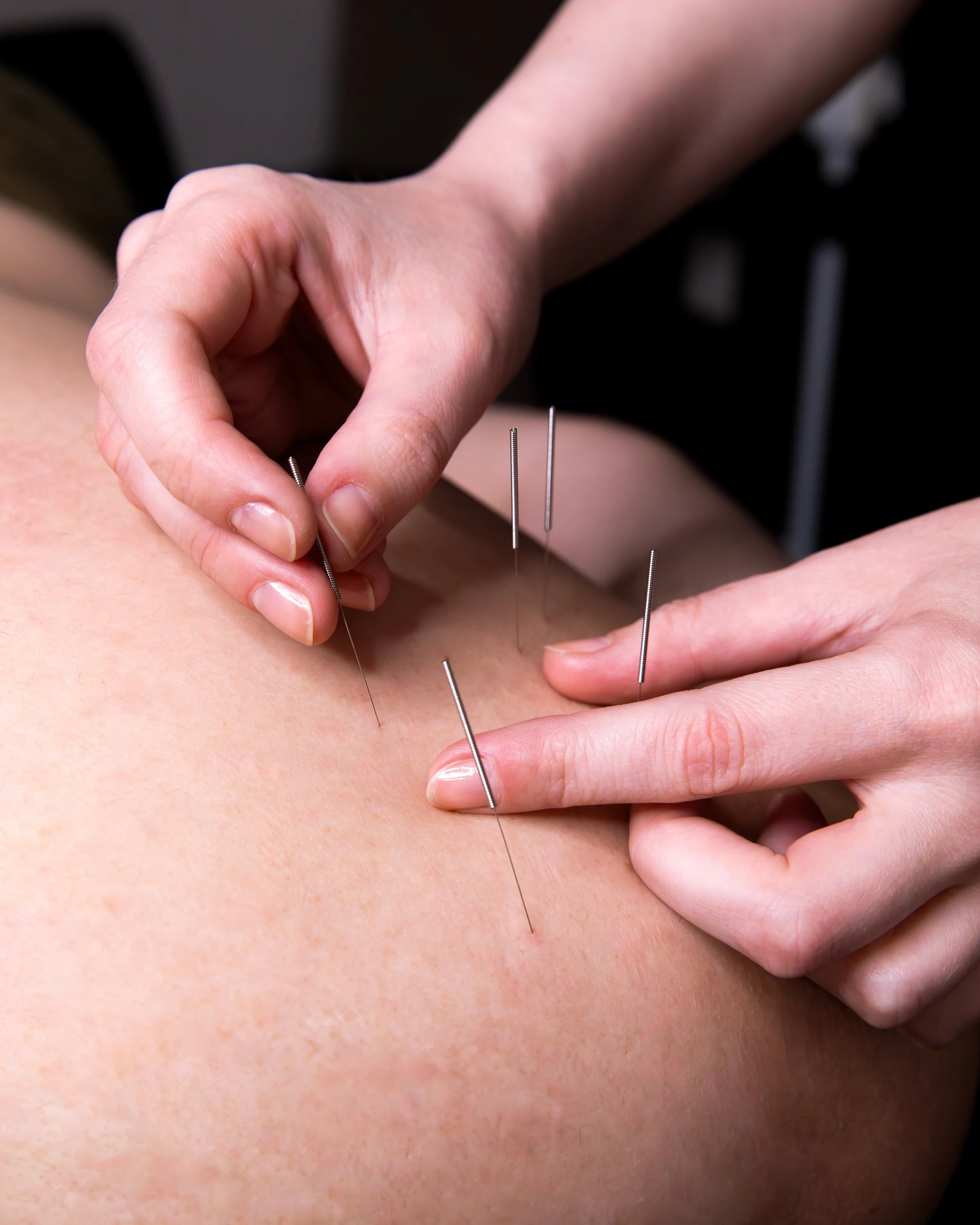 Acupuncture