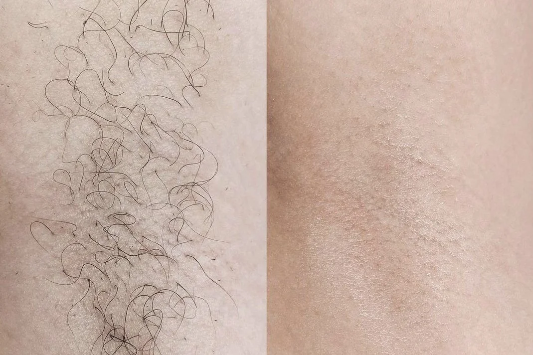laser underarm hair removal at Awareness Beauty Clinic.jpg