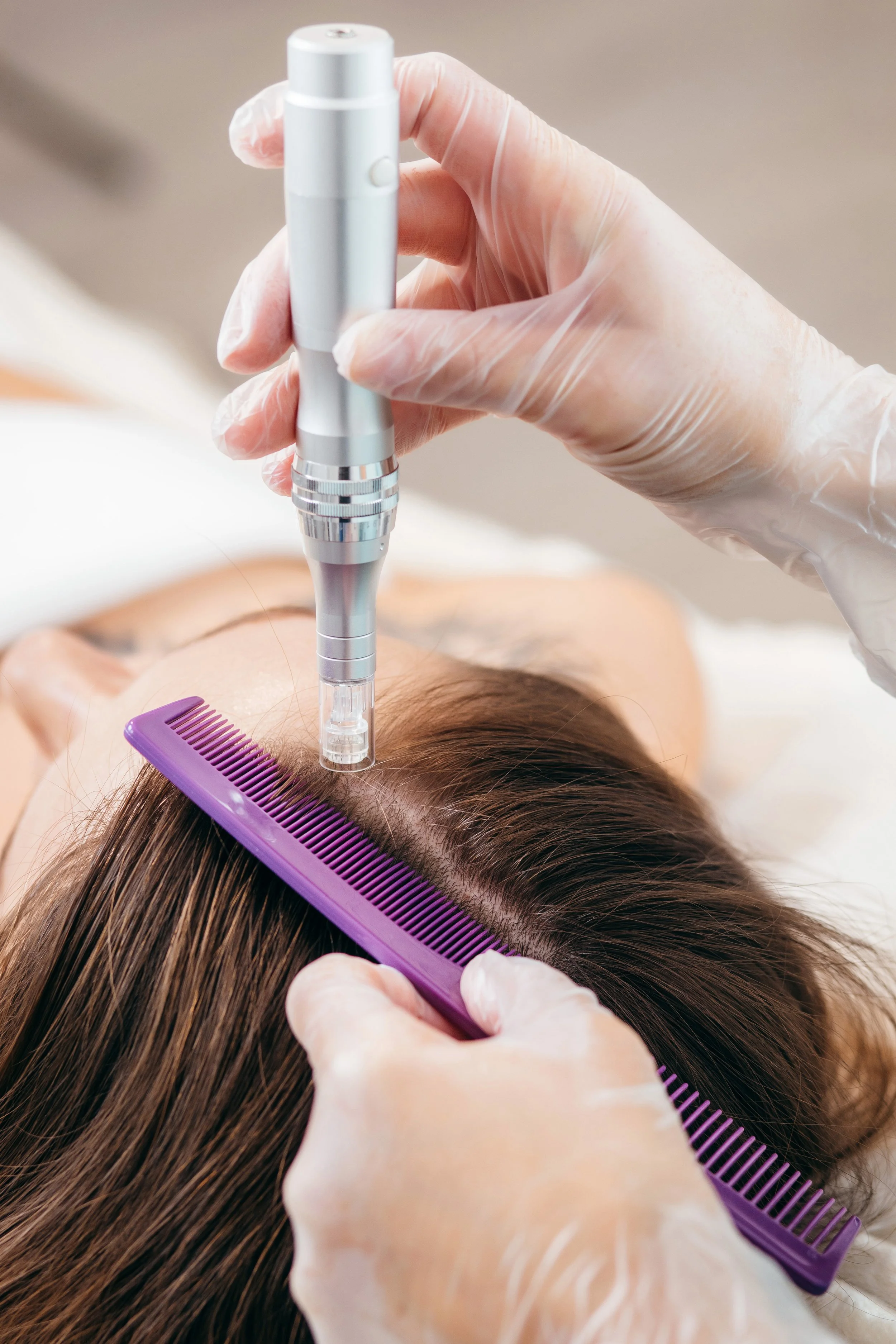 Haaruitval behandeling met mesotherapie Almere