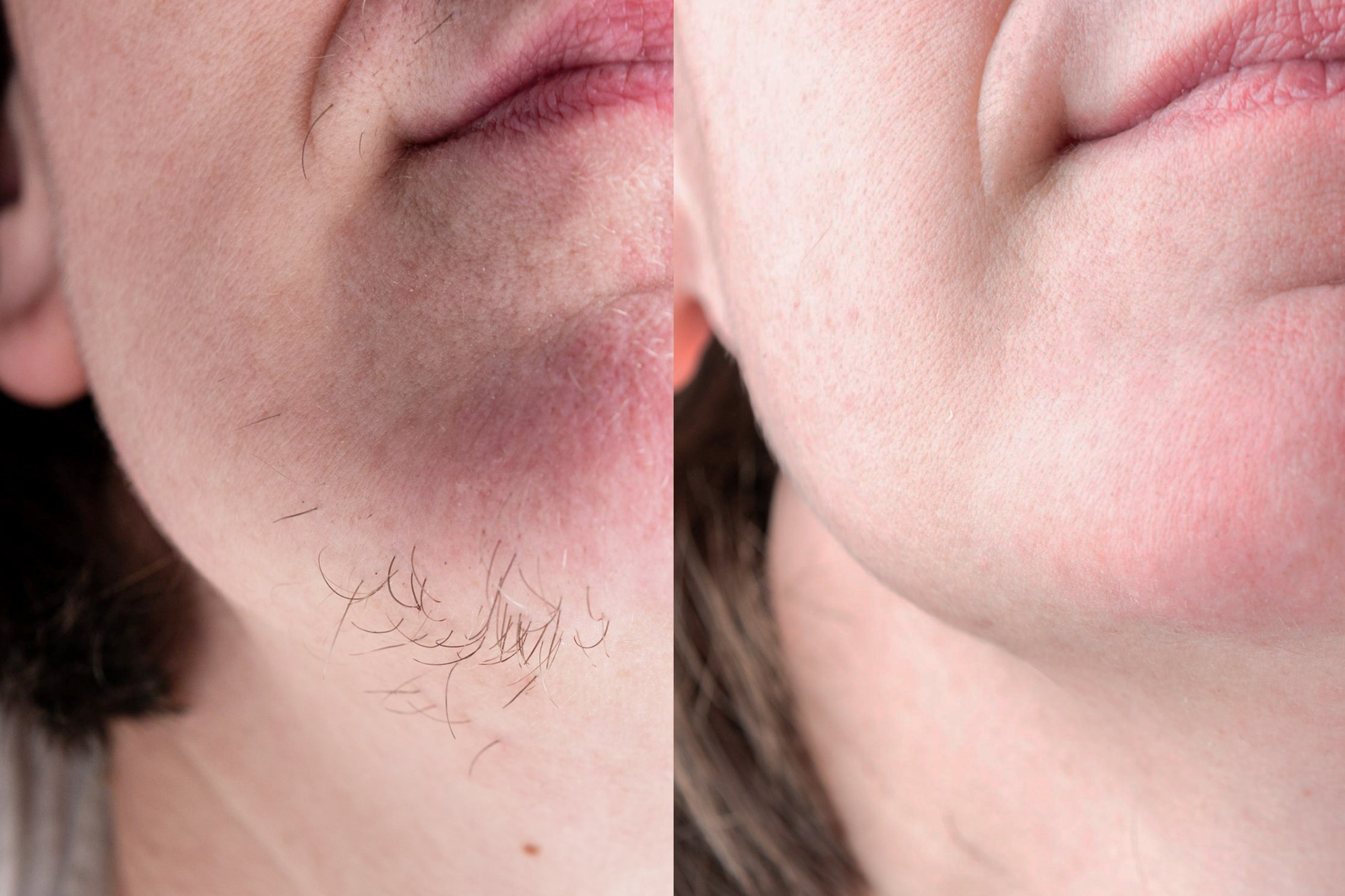 laser facial hair removal at Awareness Beauty Clinic.jpg