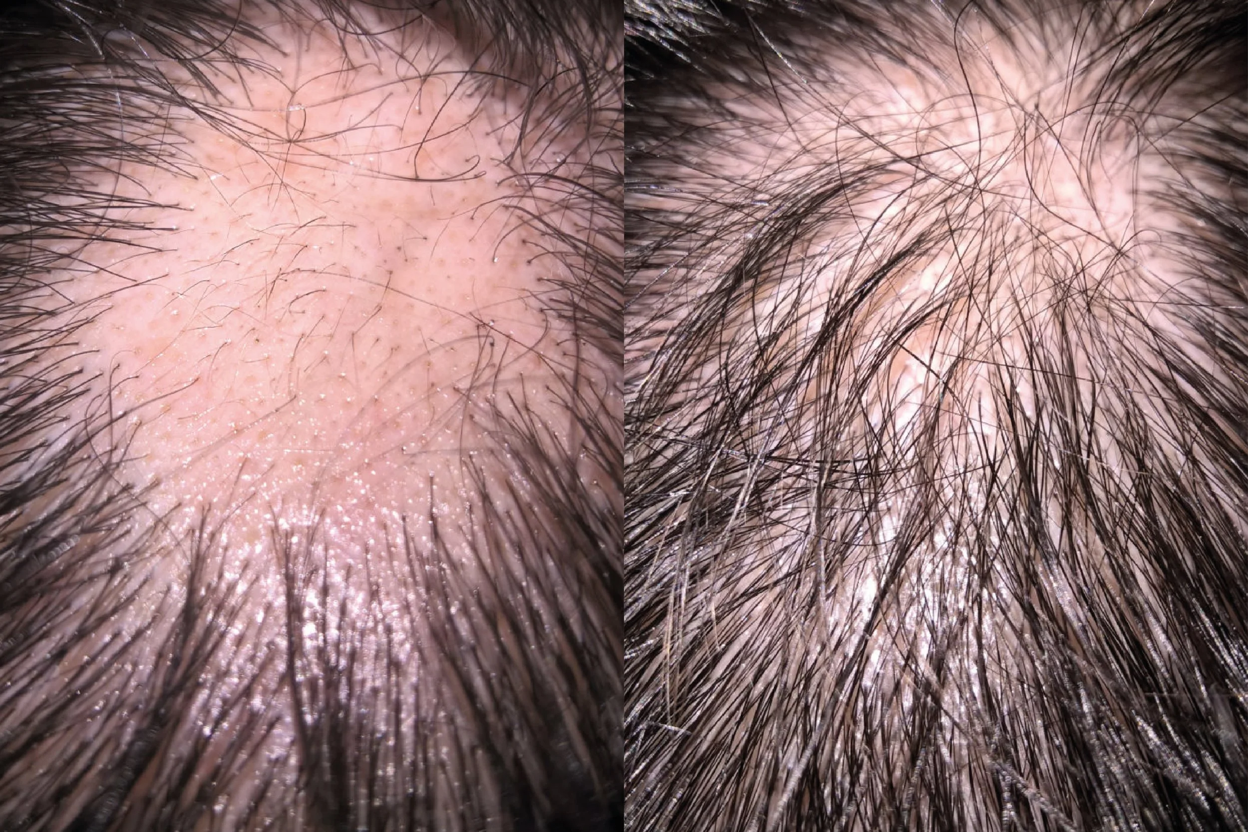 treatment of alopecia using hair mesotherapy.jpg